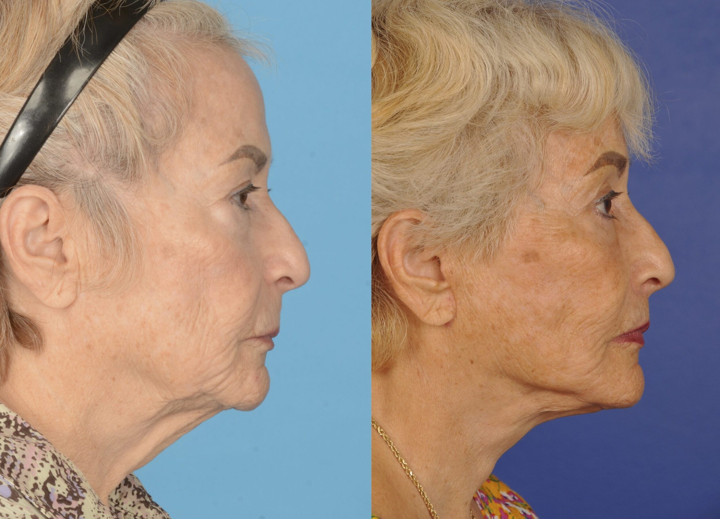 Before and After Image: Full Facial Rejuvenation - right-side