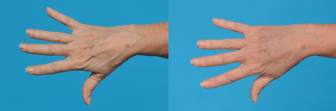 Before and After Image: Fat Grafting - other