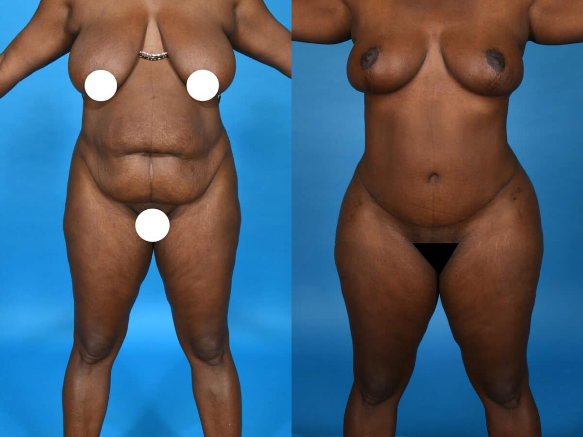 Before and After Image: Liposuction - front