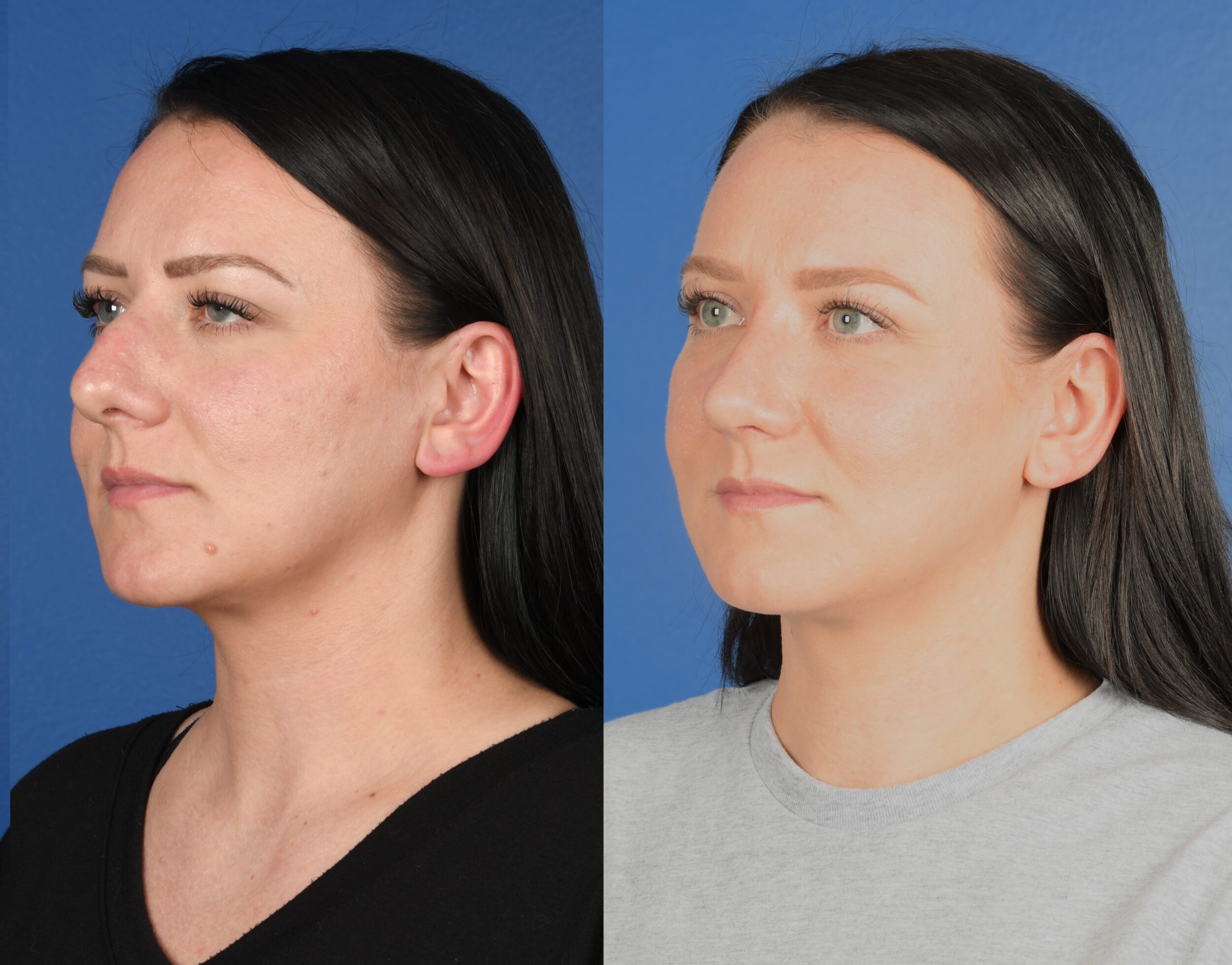Before and After Image: Primary Rhinoplasty - left-front-oblique