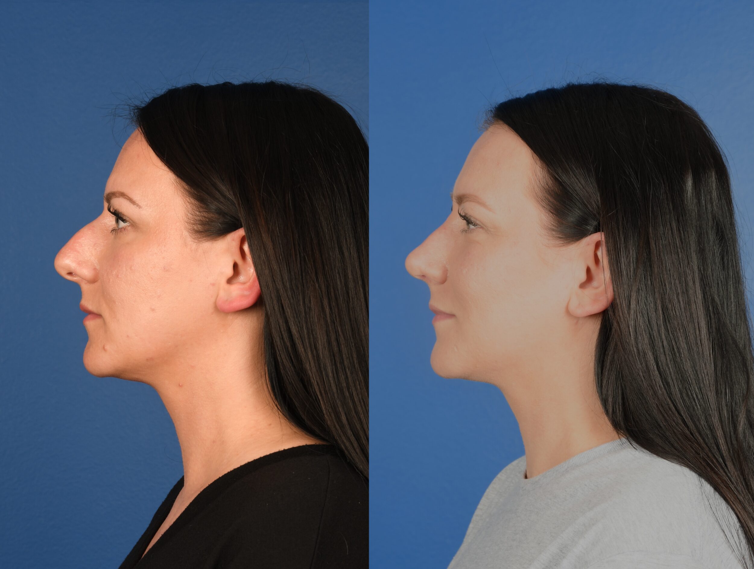 Before and After Image: Primary Rhinoplasty - left-side