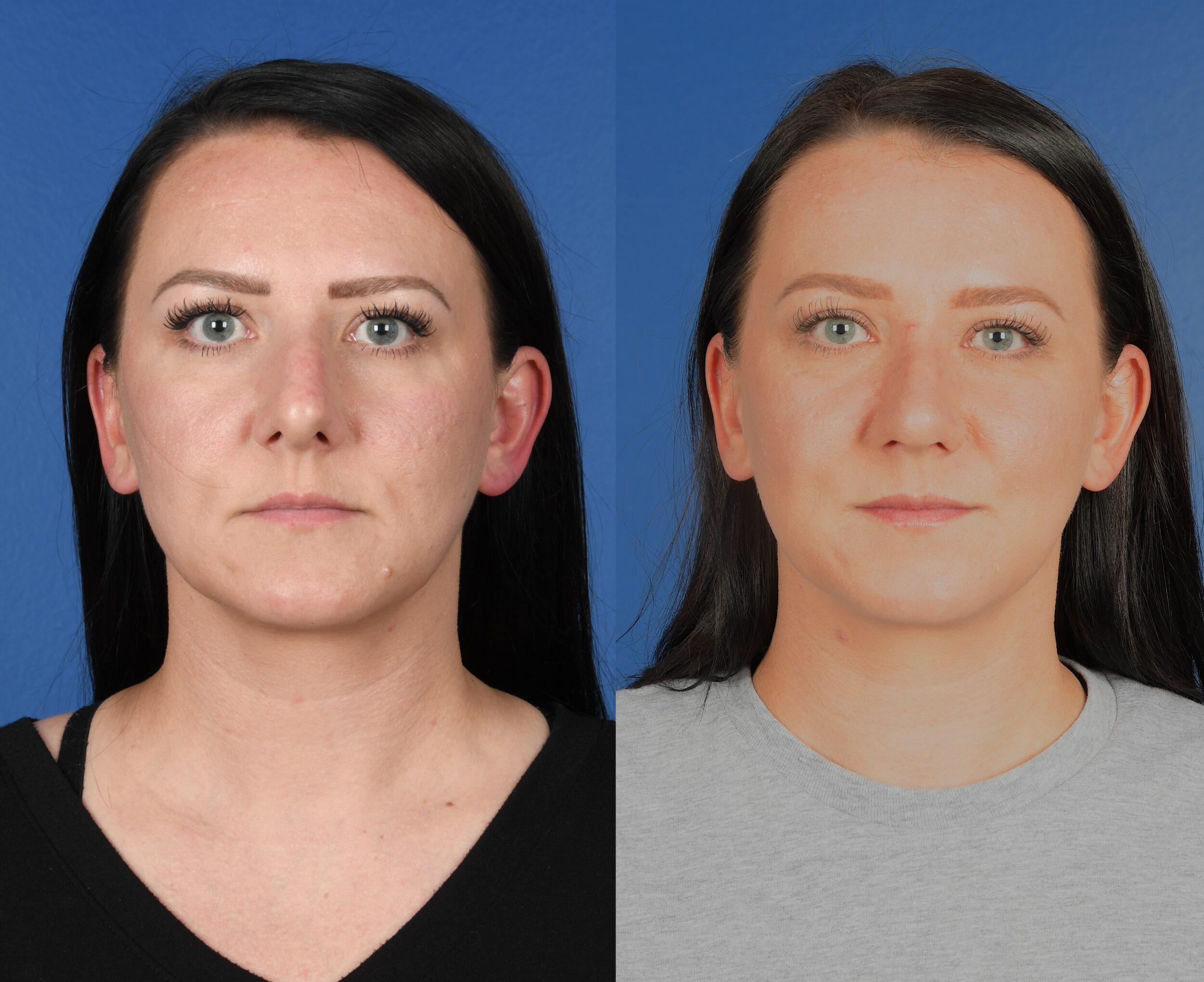 Before and After Image: Primary Rhinoplasty - front
