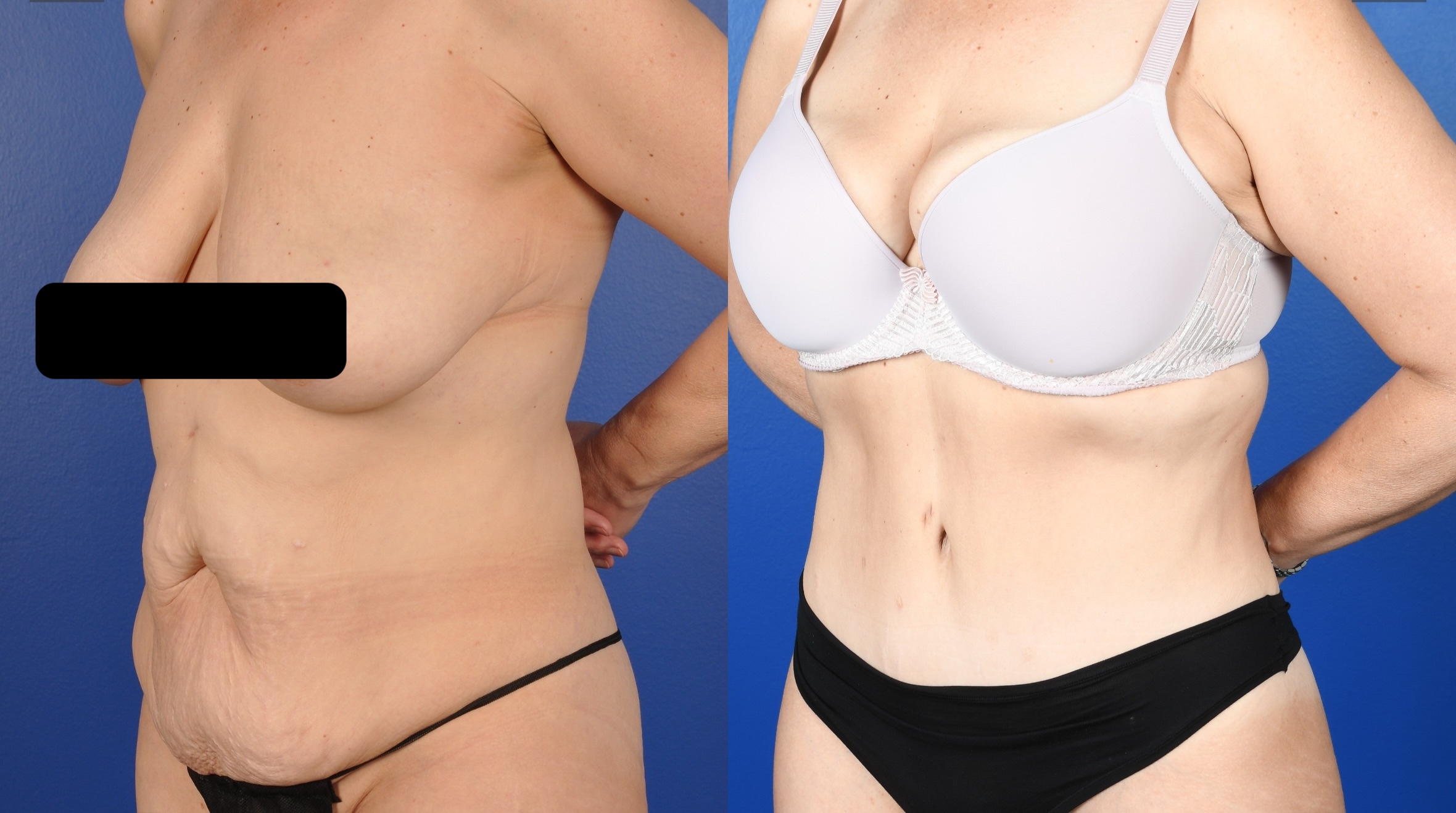 Before and After Image: Abdominoplasty, Liposuction Flanks - left-front-oblique