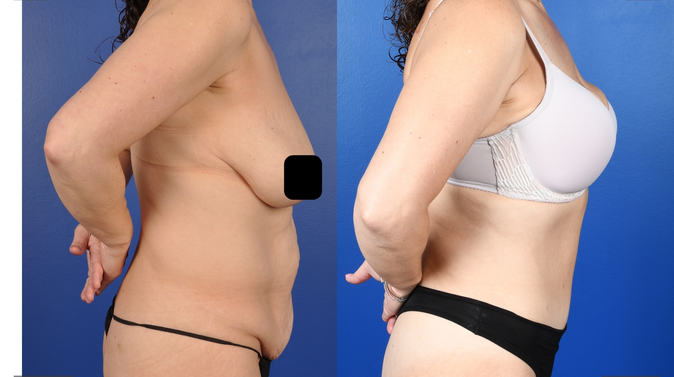 Before and After Image: Abdominoplasty, Liposuction Flanks - right-side