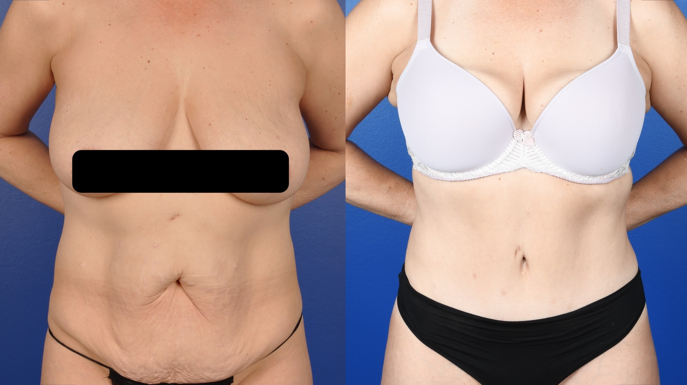 Before and After Image: Abdominoplasty, Liposuction Flanks - front