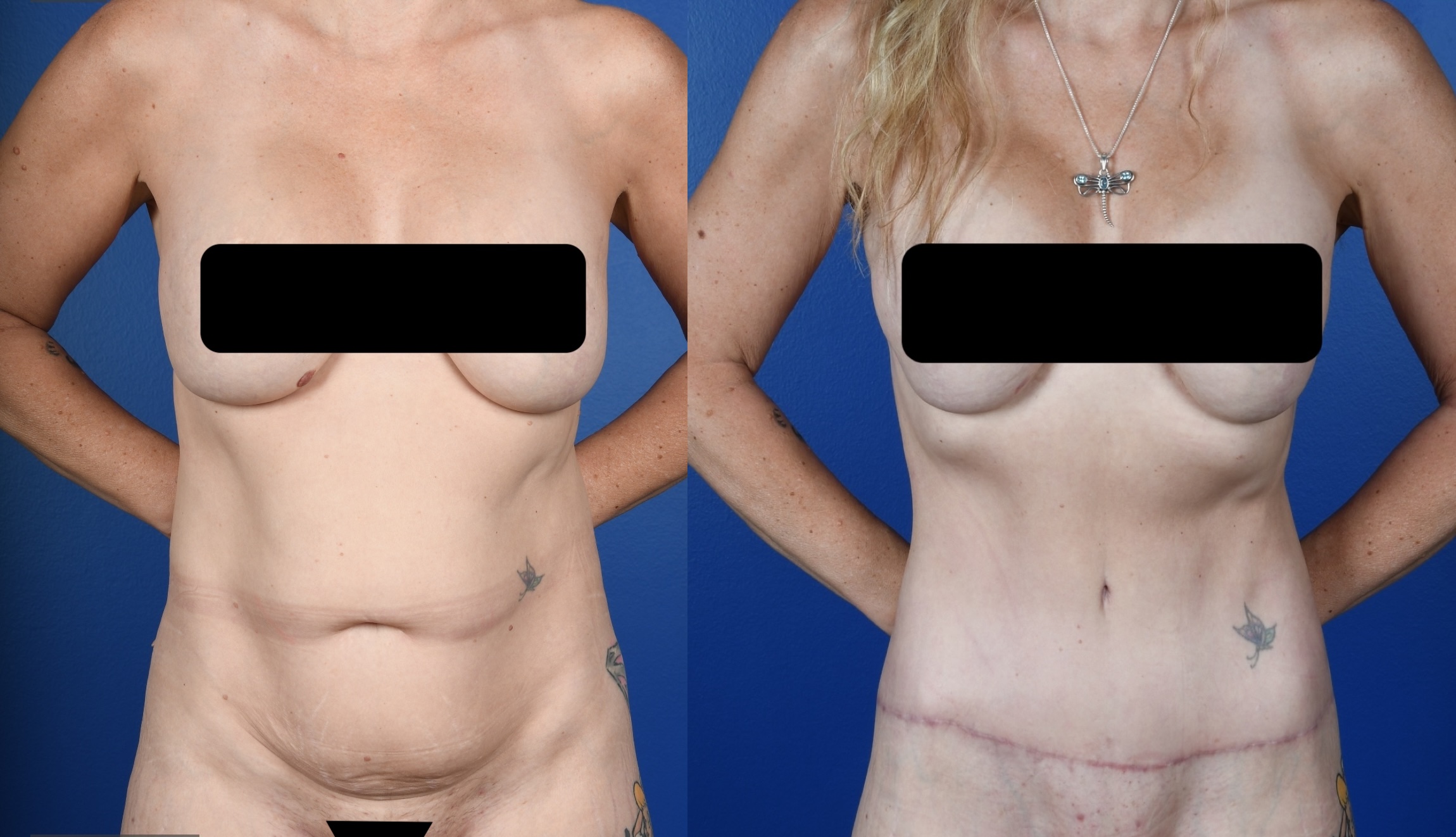 Before and After Image: Extended Abdominoplasty - front