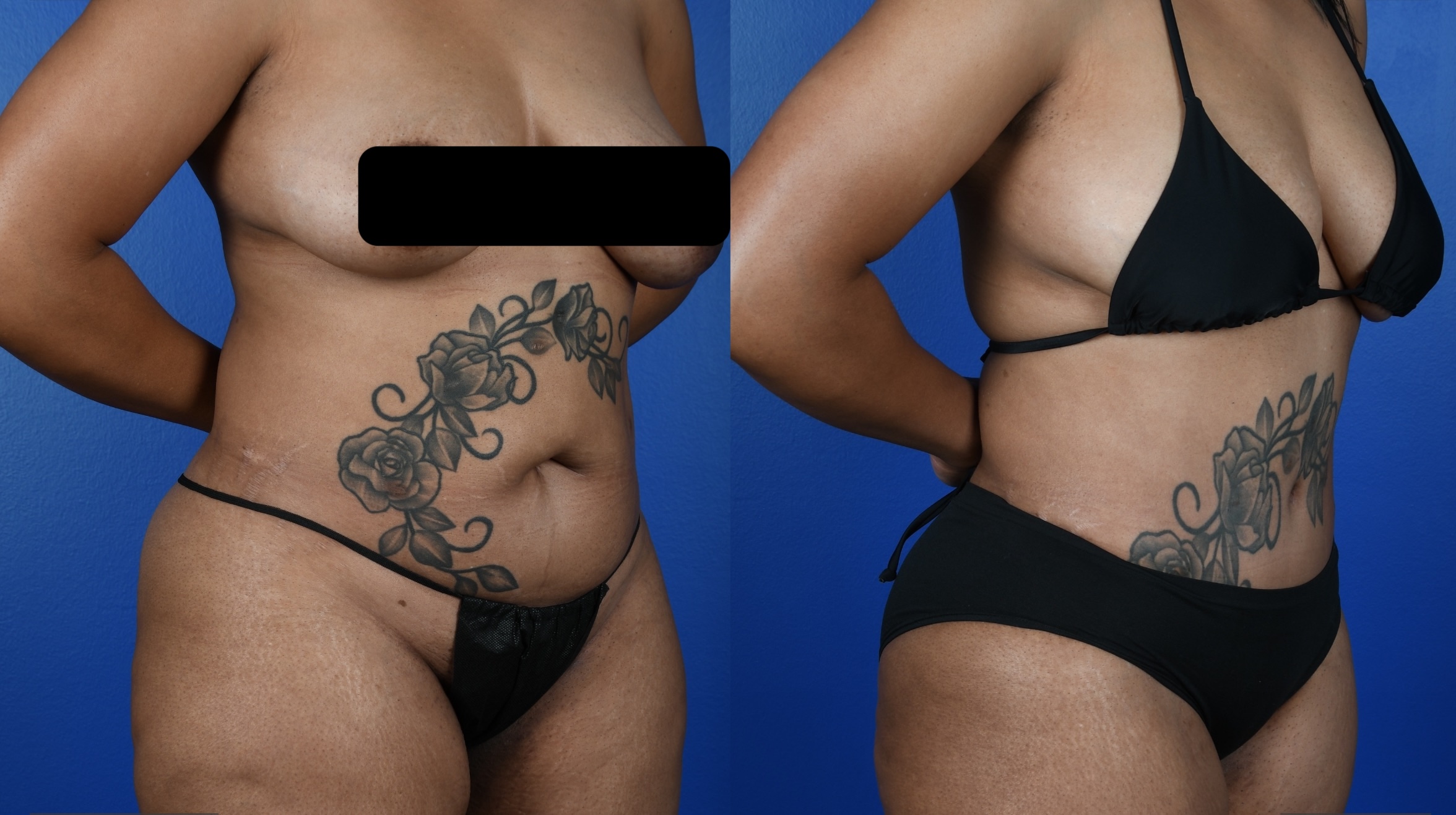 Before and After Image: Abdominoplasty, 360 VASER Liposuction - right-front-oblique