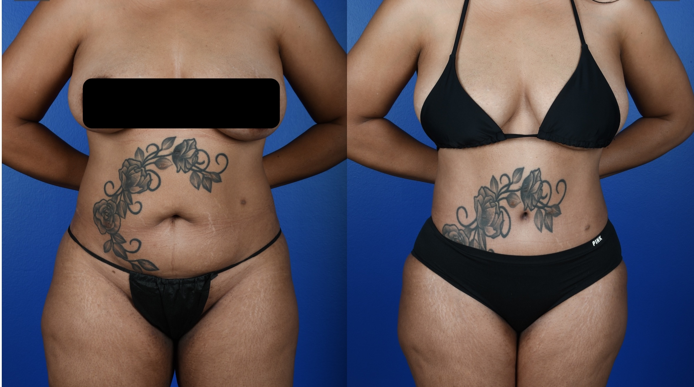 Before and After Image: Abdominoplasty, 360 VASER Liposuction - front