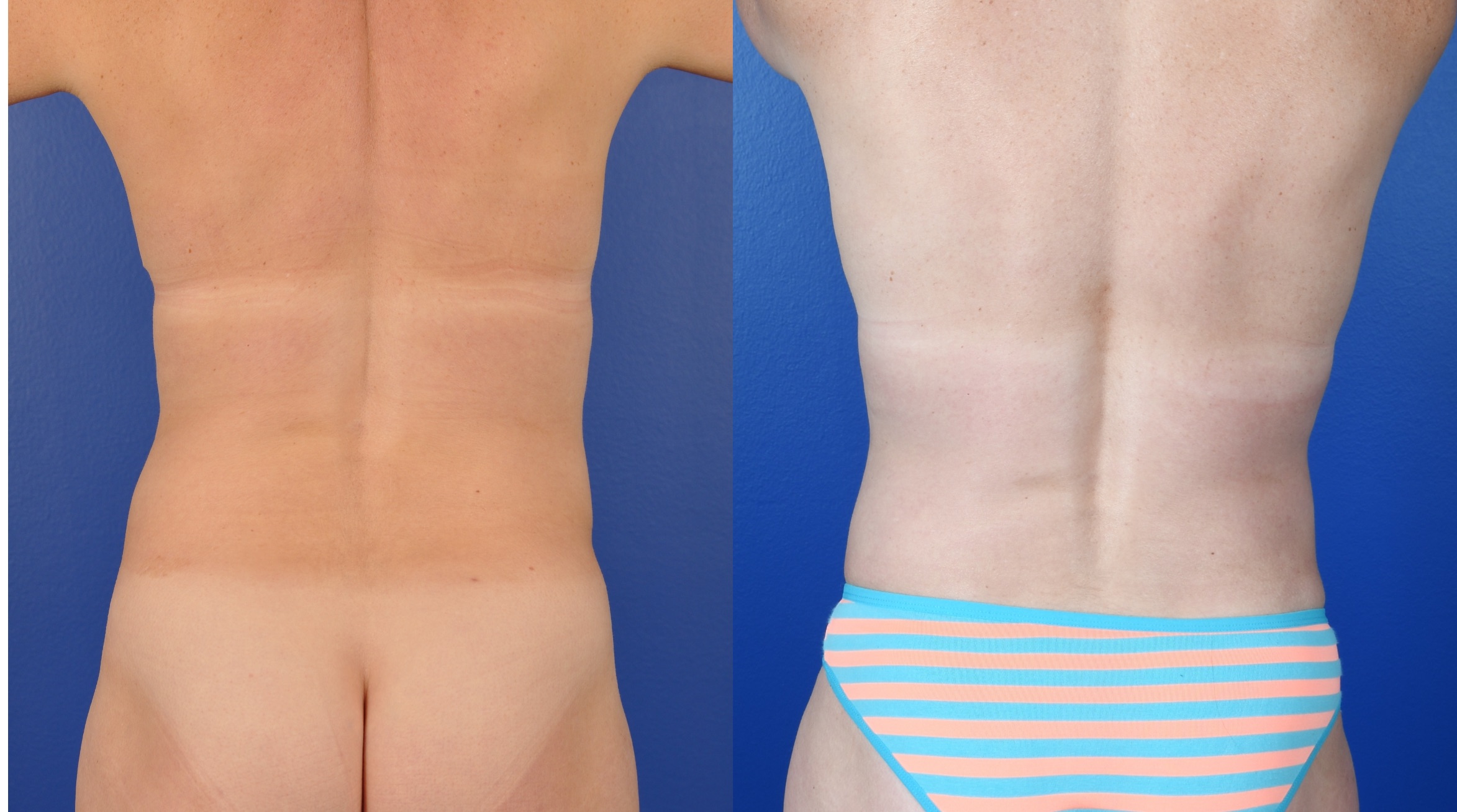 Before and After Image: Abdominoplasty, 360 Liposuction, Axillary Liposuction, Breast Augmentation – Silicone, Inverted Nipple Repair - back