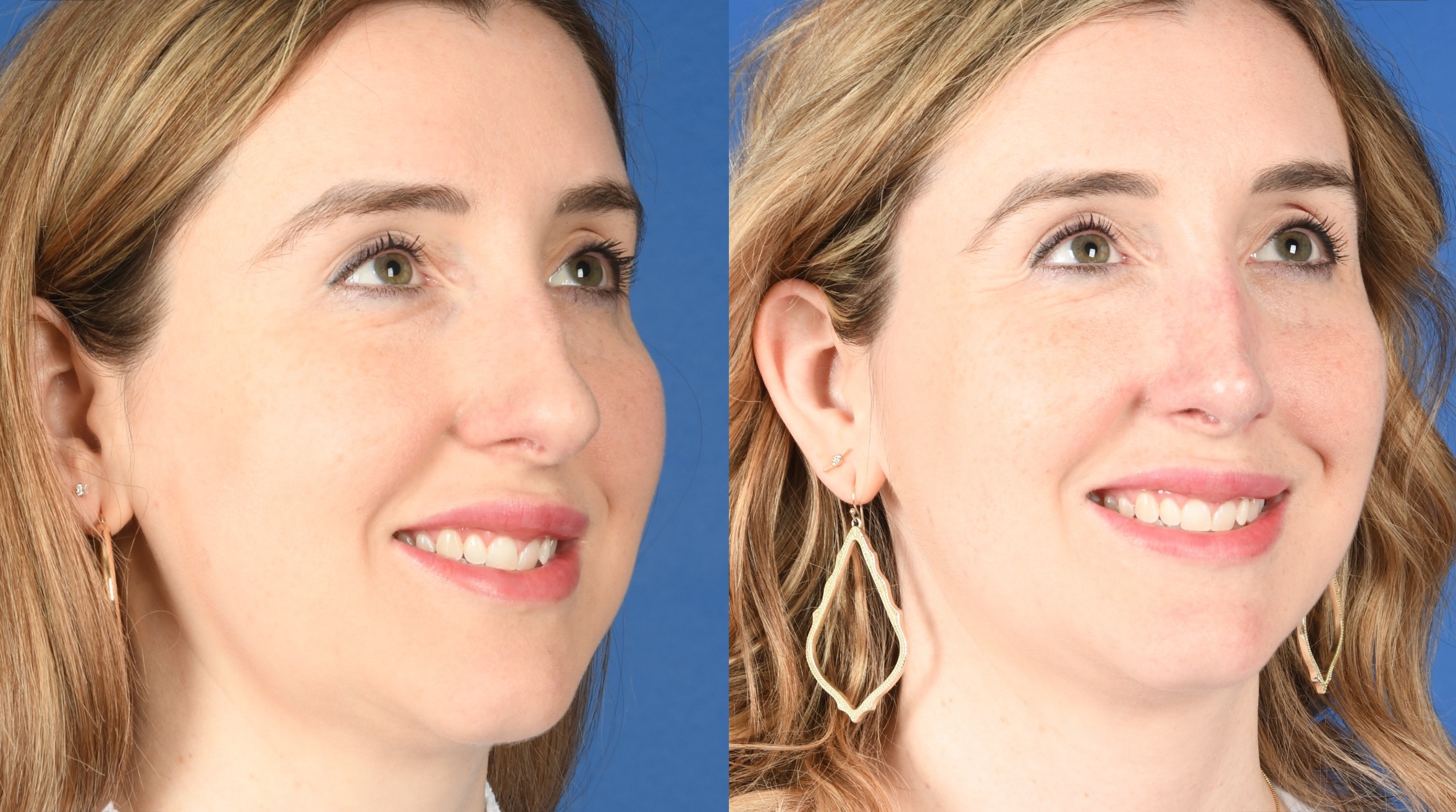 Before and After Image: Primary Rhinoplasty - right-front-oblique