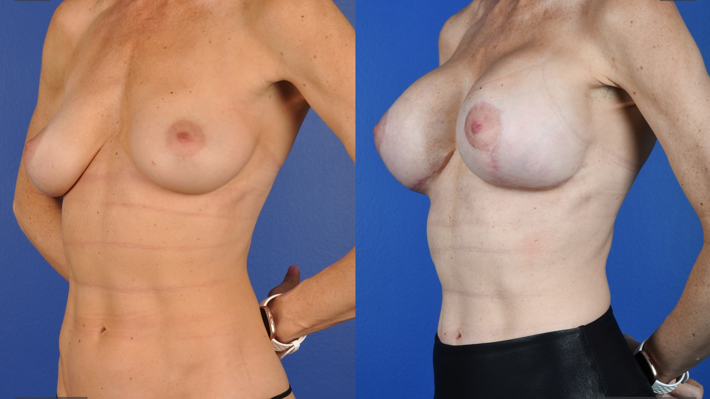 Before and After Image: Breast Augmentation – Silicone, Mastopexy - left-front-oblique