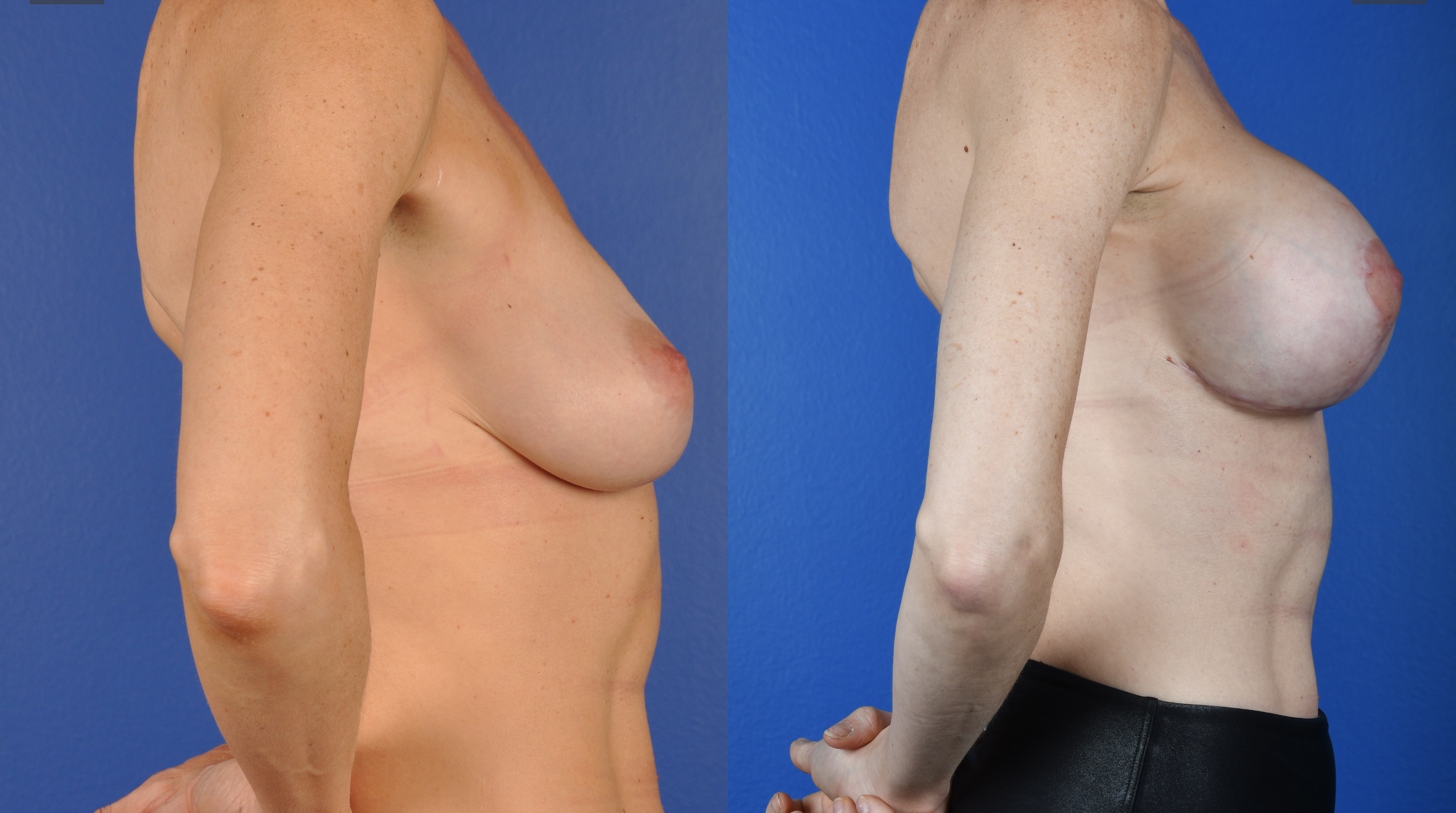 Before and After Image: Breast Augmentation – Silicone, Mastopexy - right-side