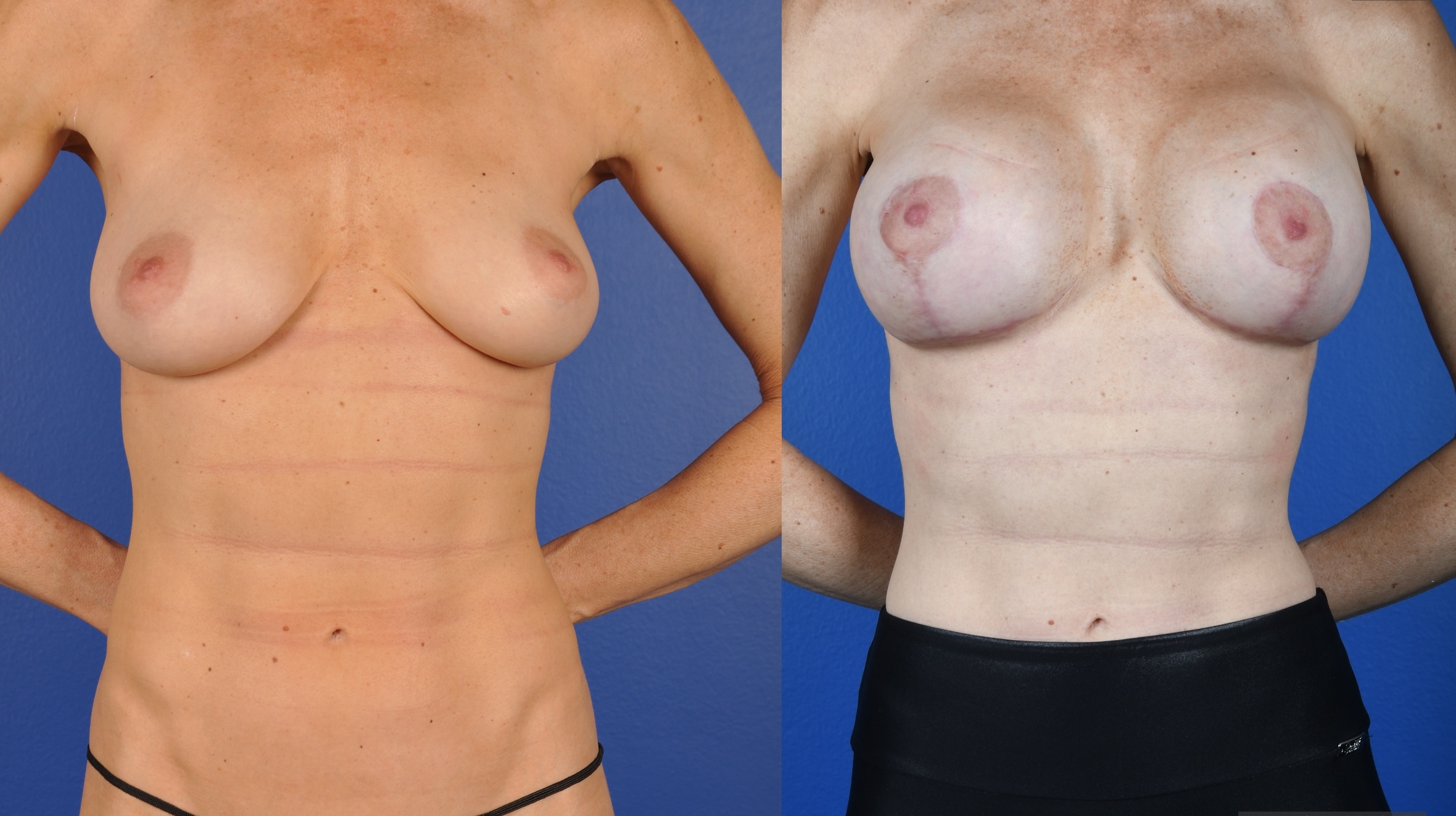 Before and After Image: Breast Augmentation – Silicone, Mastopexy - front