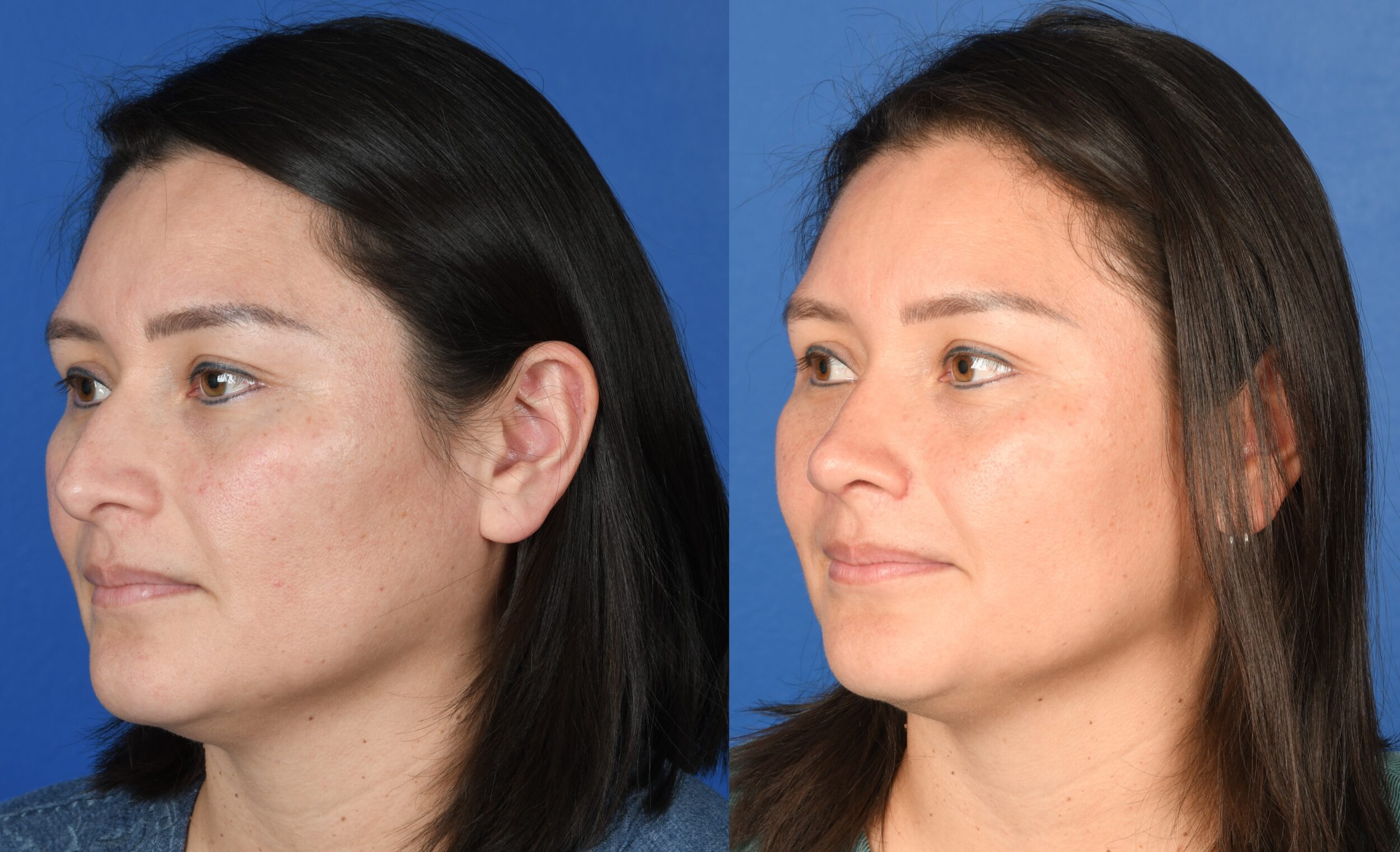 Before and After Image: Primary Rhinoplasty - left-front-oblique