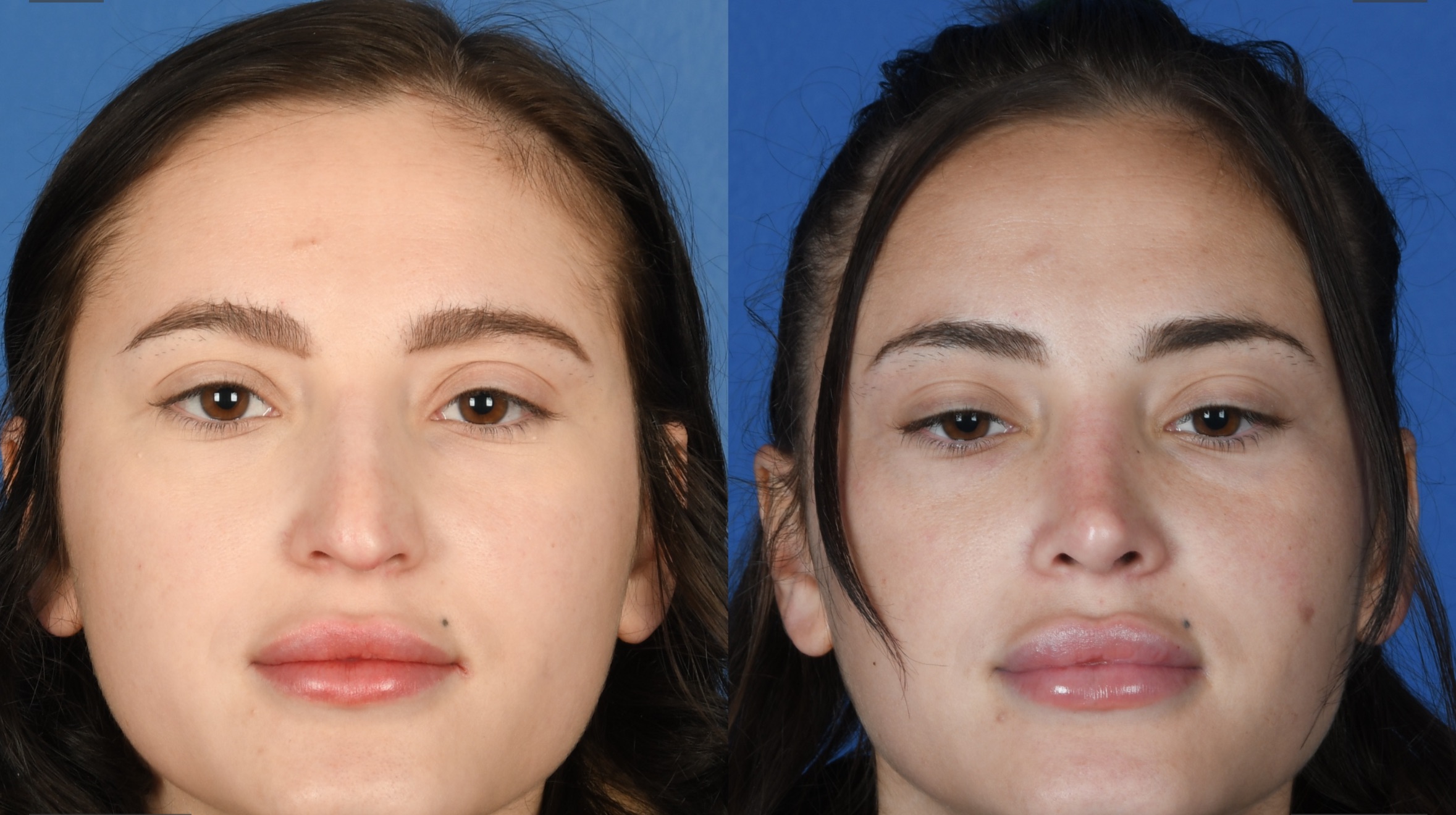 Before and After Image: Primary Rhinoplasty - front