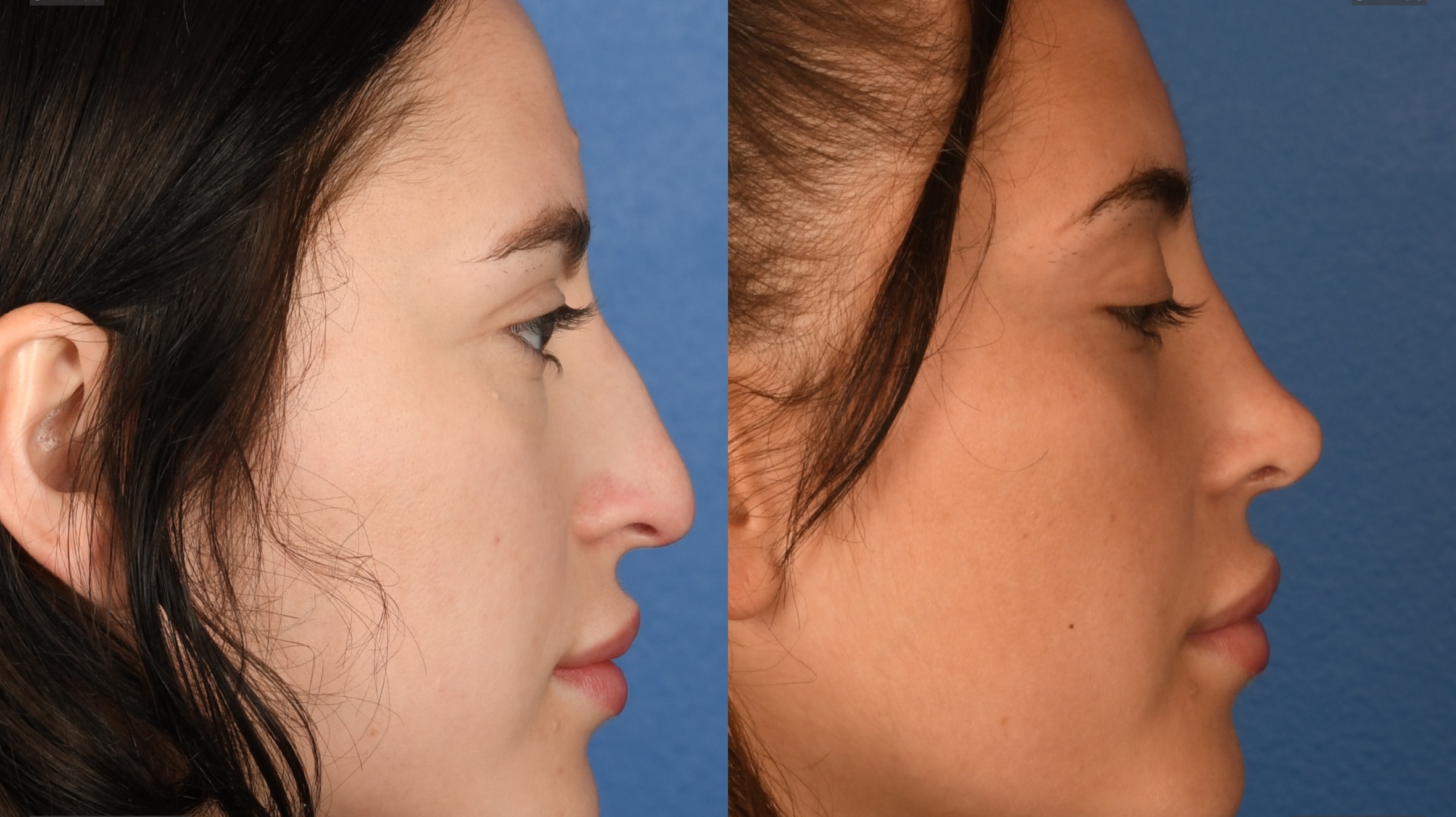 Before and After Image: Primary Rhinoplasty - right-front-oblique
