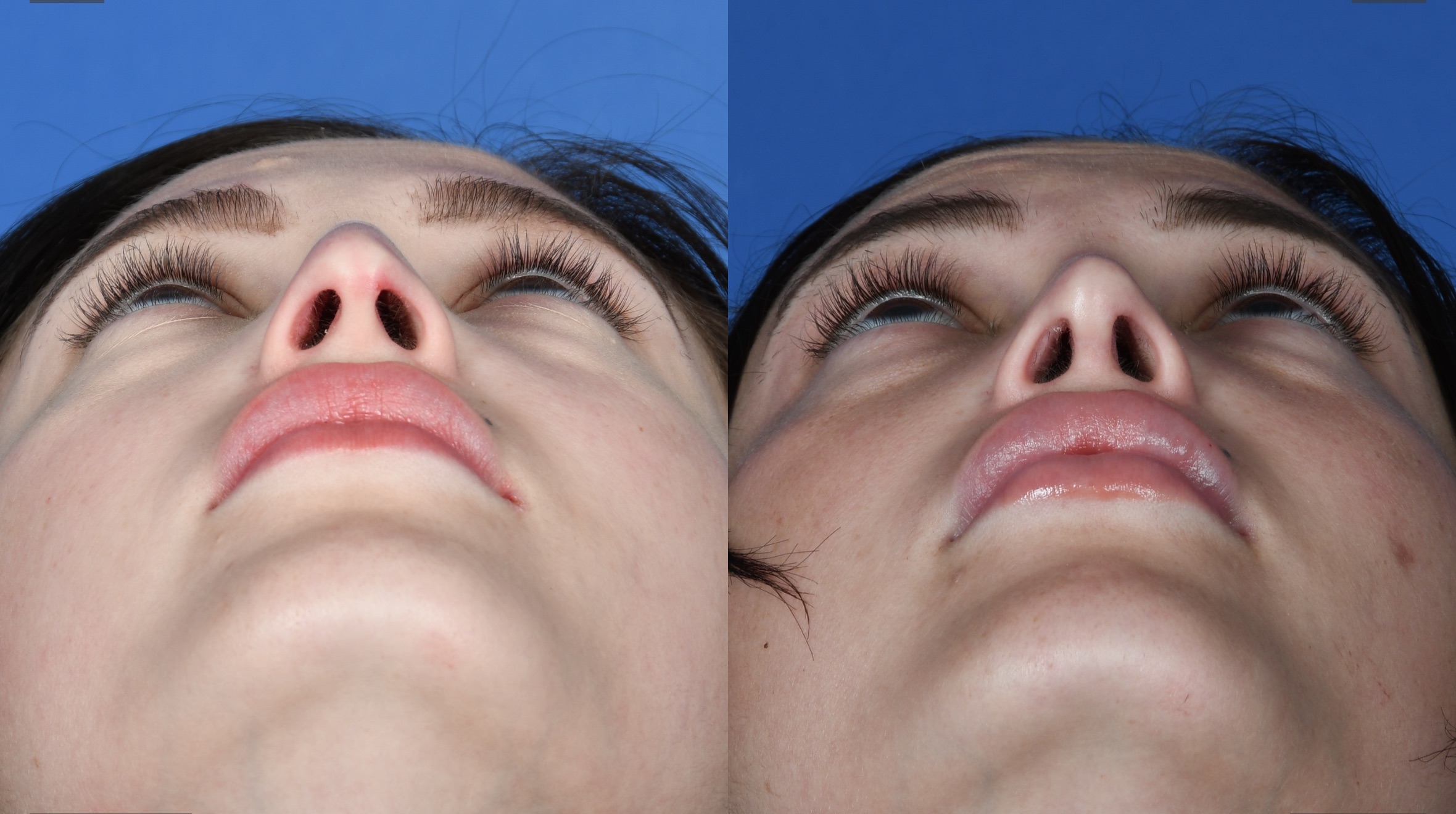 Before and After Image: Primary Rhinoplasty - other