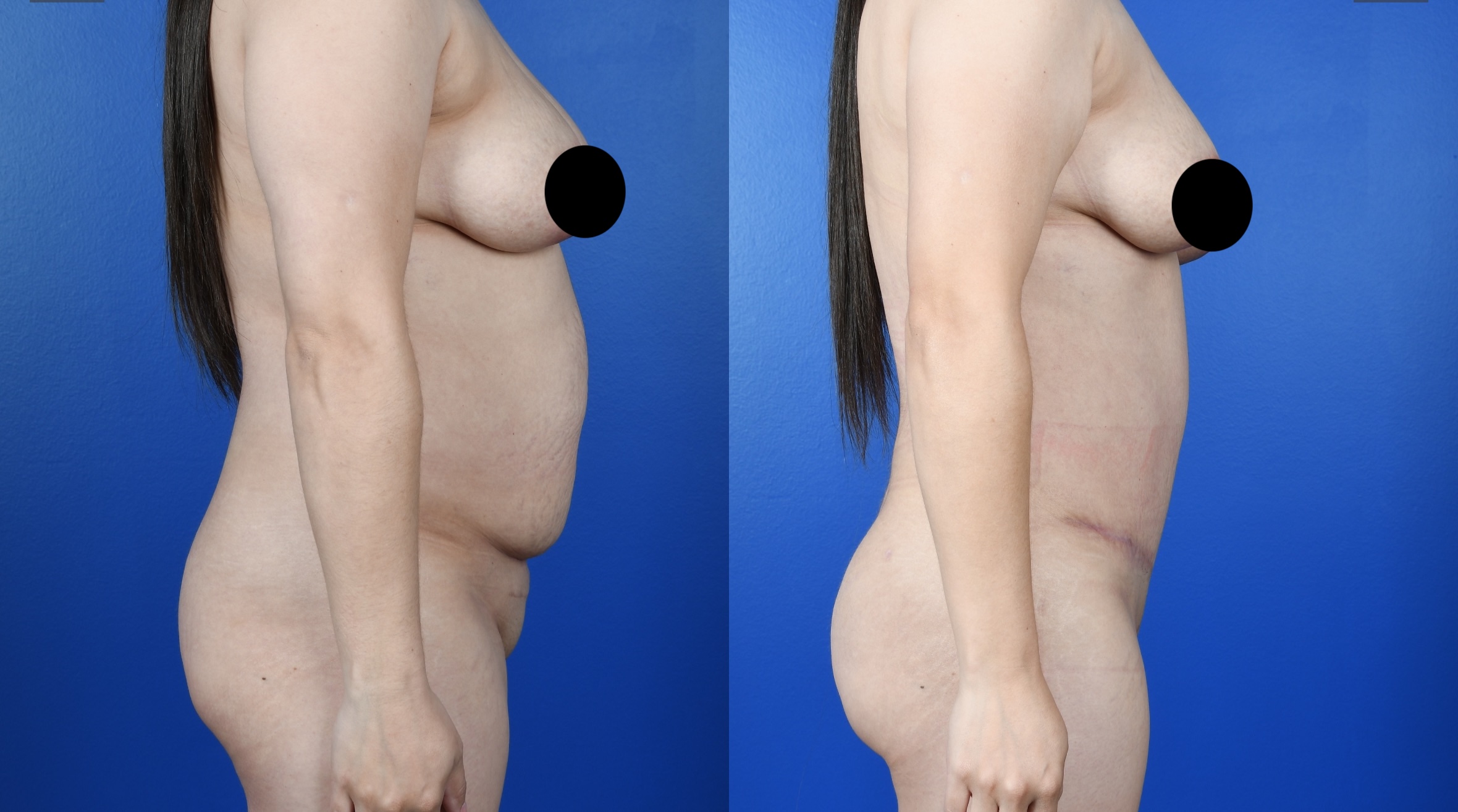 Before and After Image: Abdominoplasty, Fat Transfer to Buttocks - right-side