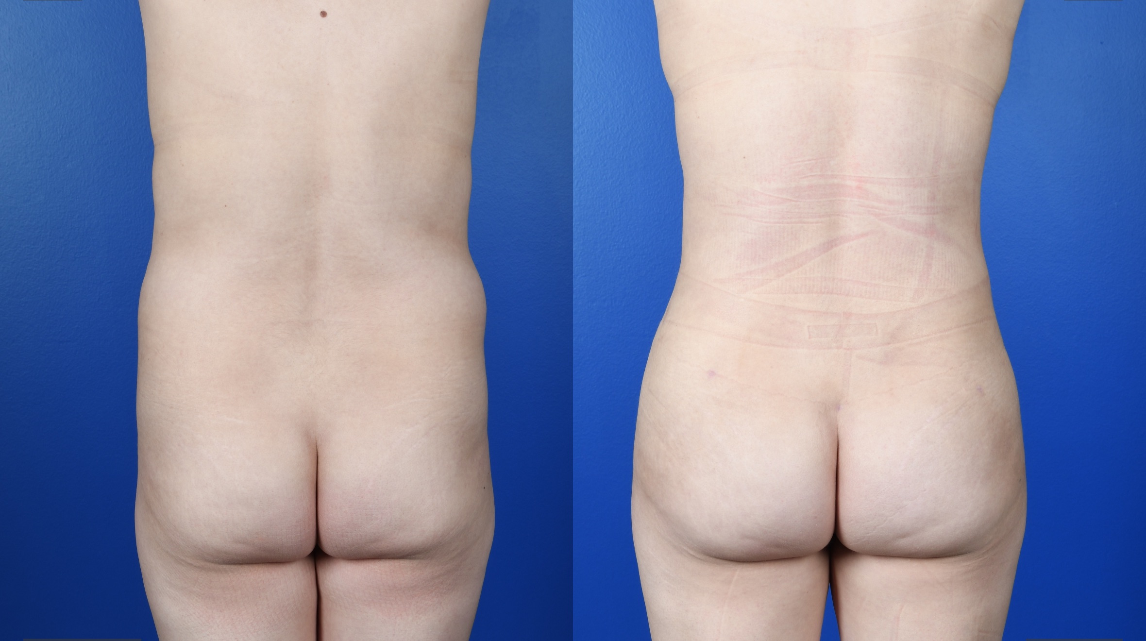 Before and After Image: Abdominoplasty, Fat Transfer to Buttocks - back
