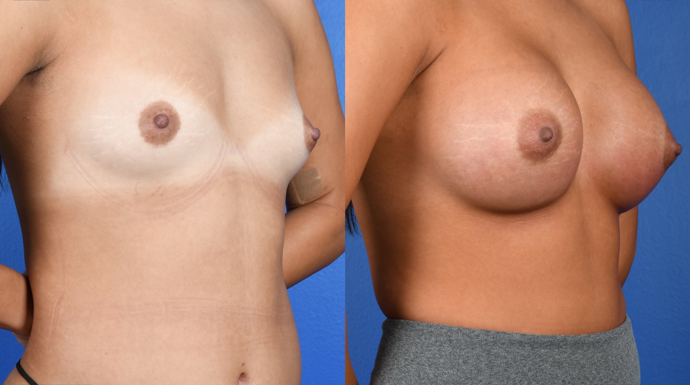 Before and After Image: Breast Augmentation – Silicone - right-front-oblique