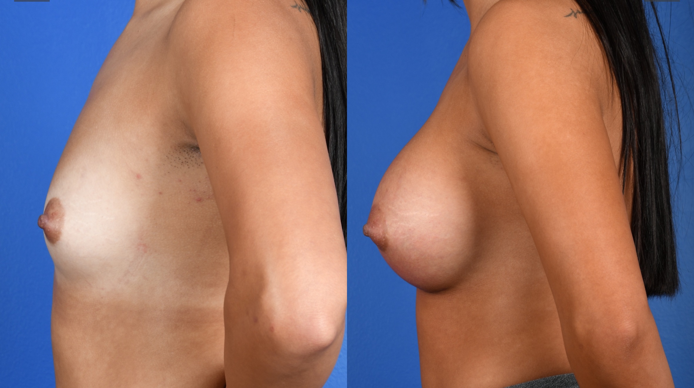 Before and After Image: Breast Augmentation – Silicone - left-side