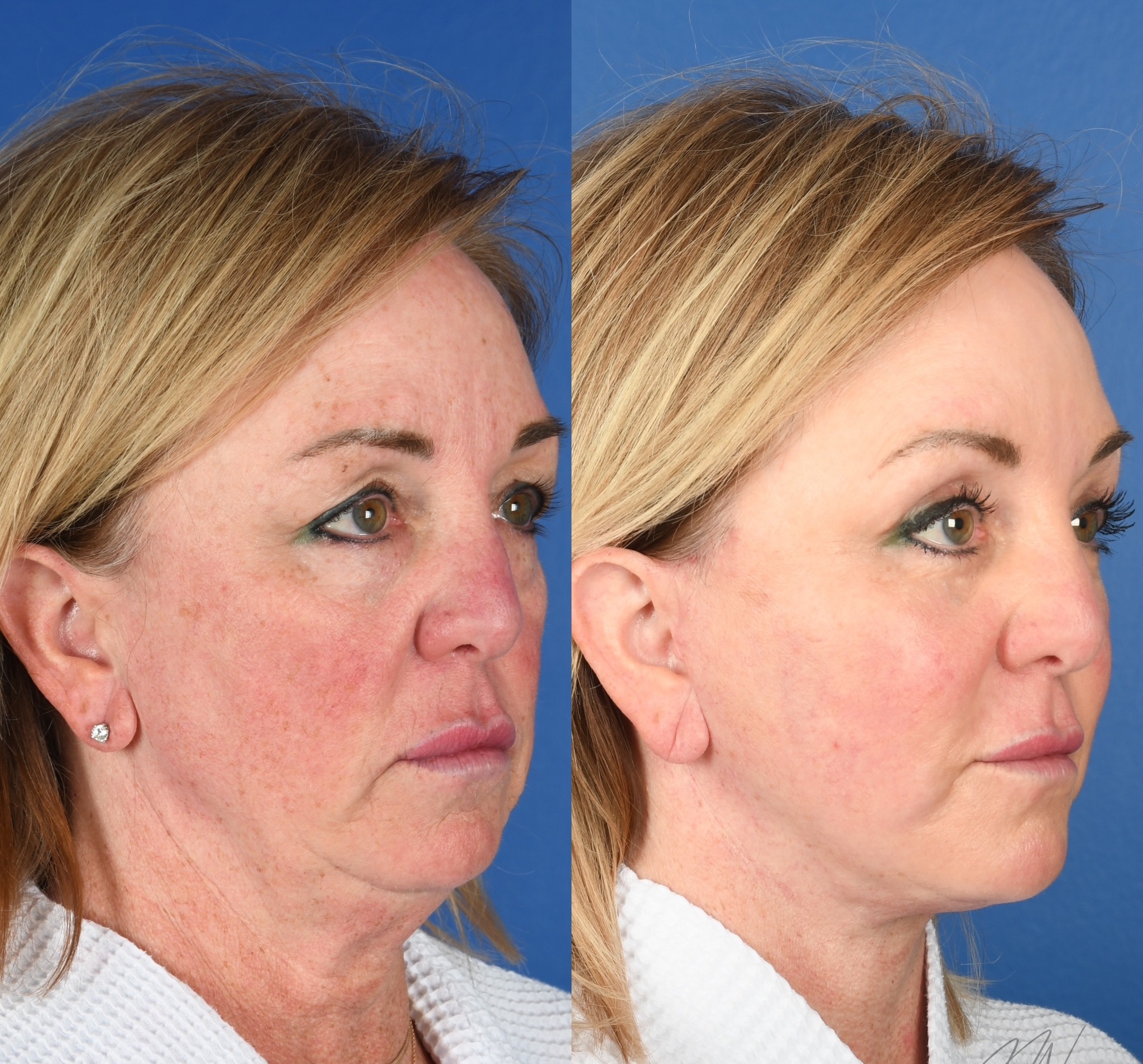 Before and After Image: Facelift, Facial Fat Grafting, Upper and Lower Blepharoplasty, Full Face Laser Resurfacing - right-front-oblique
