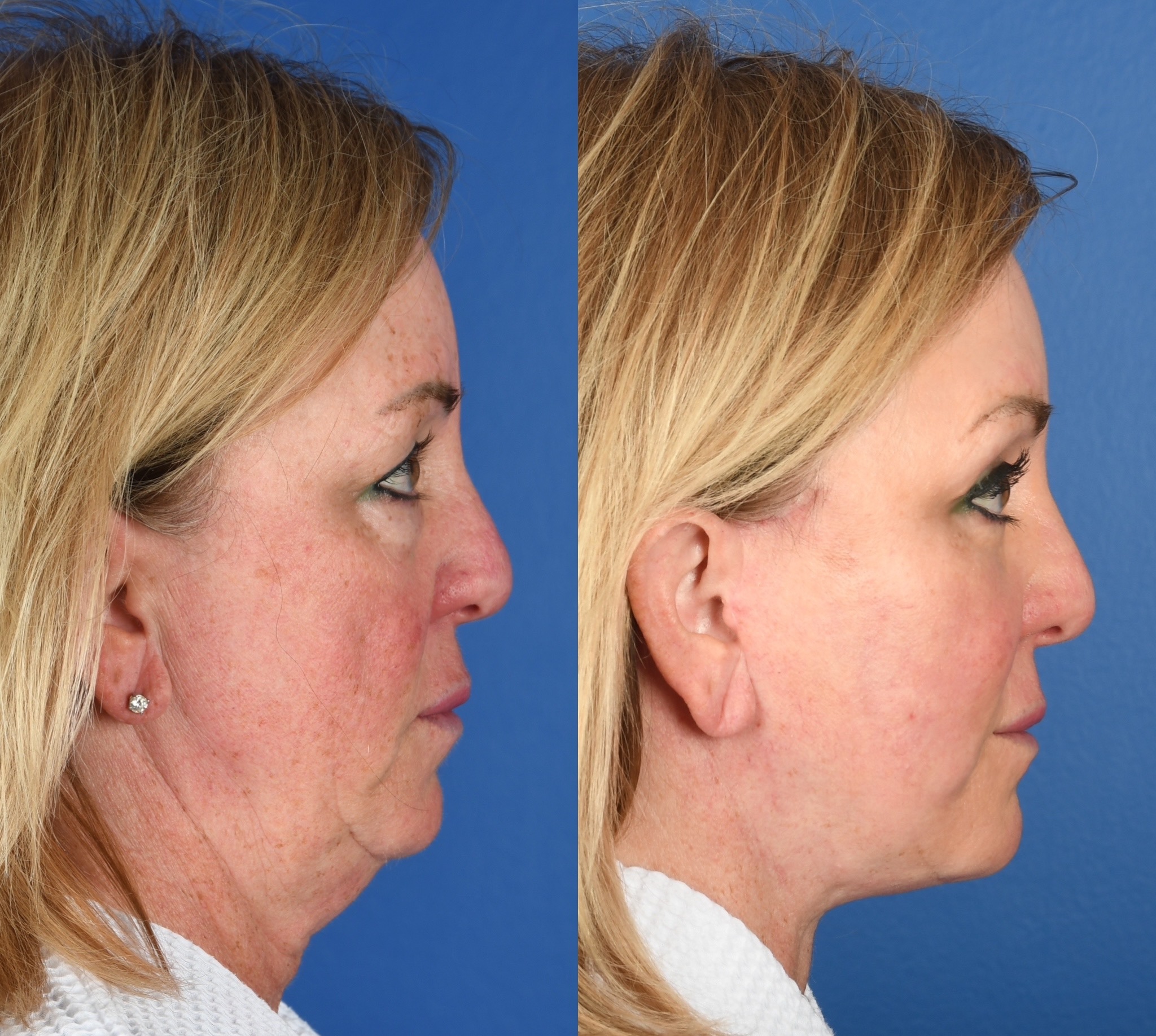 Before and After Image: Facelift, Facial Fat Grafting, Upper and Lower Blepharoplasty, Full Face Laser Resurfacing - right-side