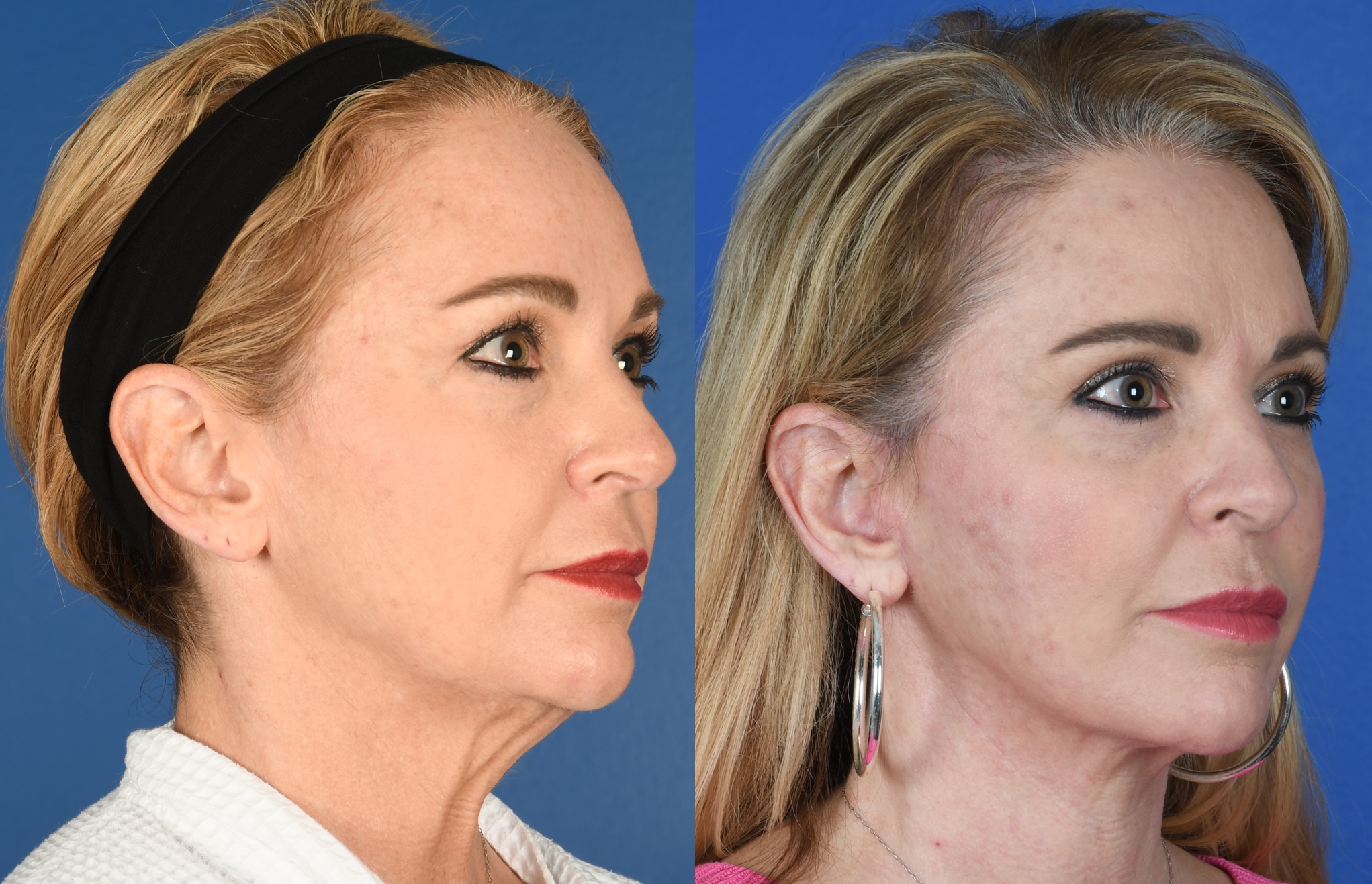 Before and After Image: Upper Blepharoplasty, Facelift, Facial Fat Grafting - right-front-oblique