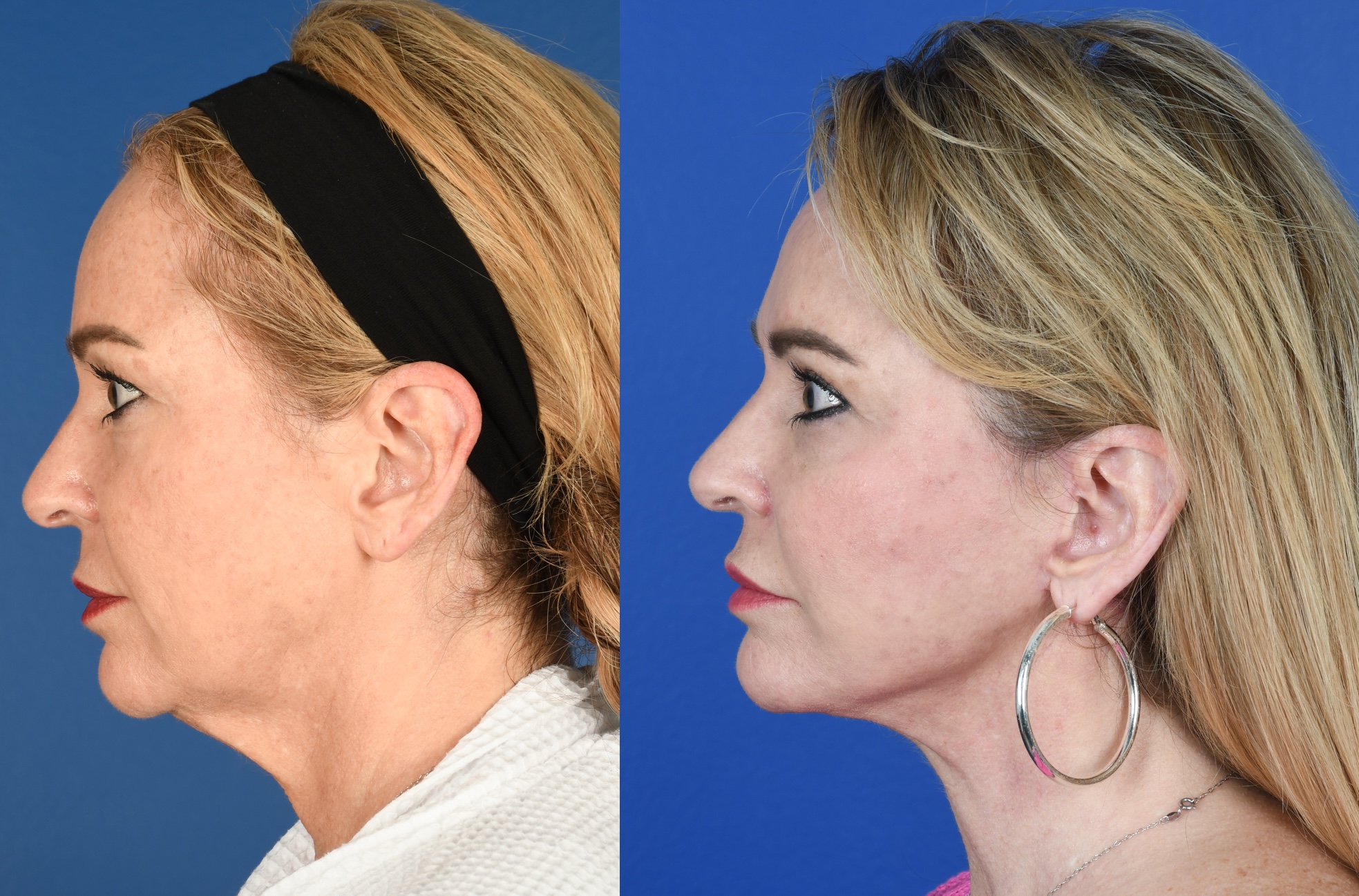 Before and After Image: Upper Blepharoplasty, Facelift, Facial Fat Grafting - left-side
