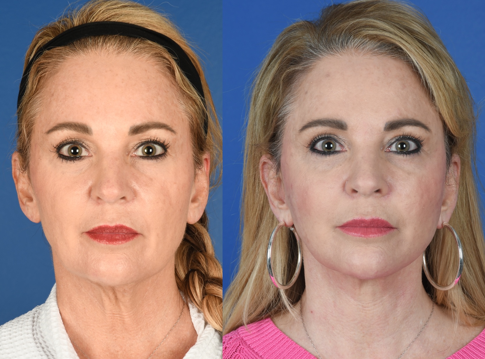 Before and After Image: Upper Blepharoplasty, Facelift, Facial Fat Grafting - front