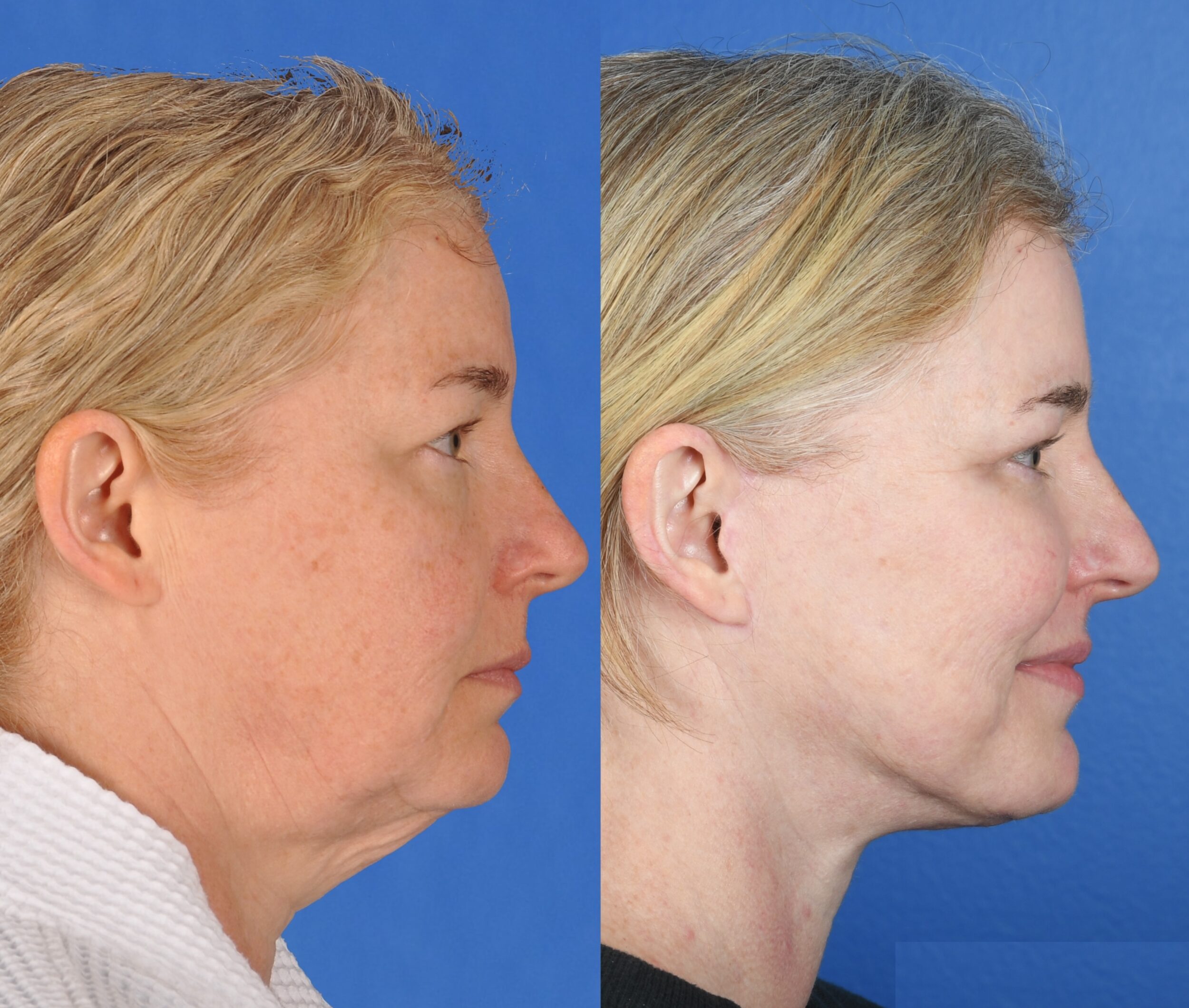 Before and After Image: Facelift, Upper and Lower Blepharoplasty, Full Face Laser - right-front-oblique