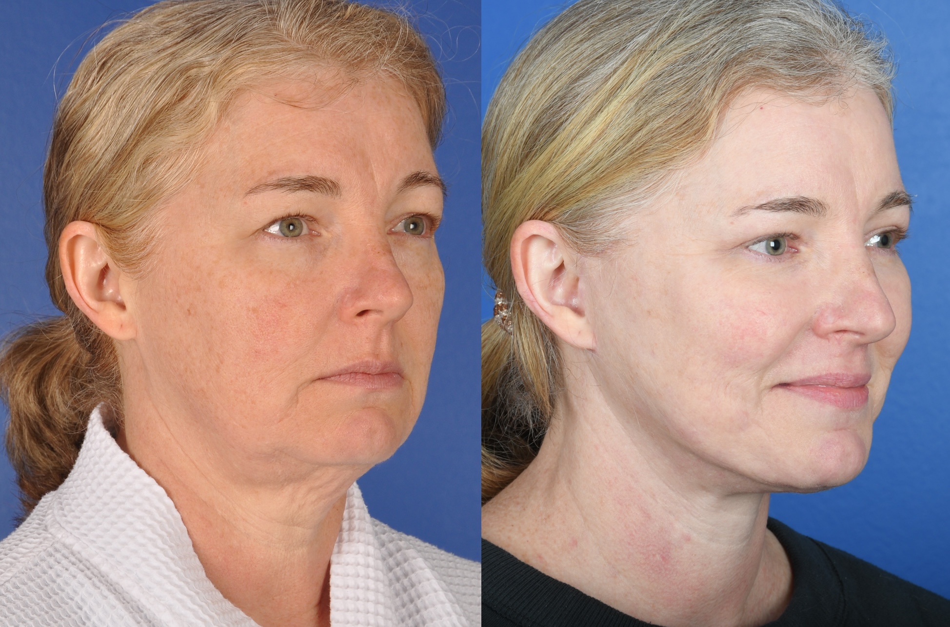 Before and After Image: Facelift, Upper and Lower Blepharoplasty, Full Face Laser - right-front-oblique