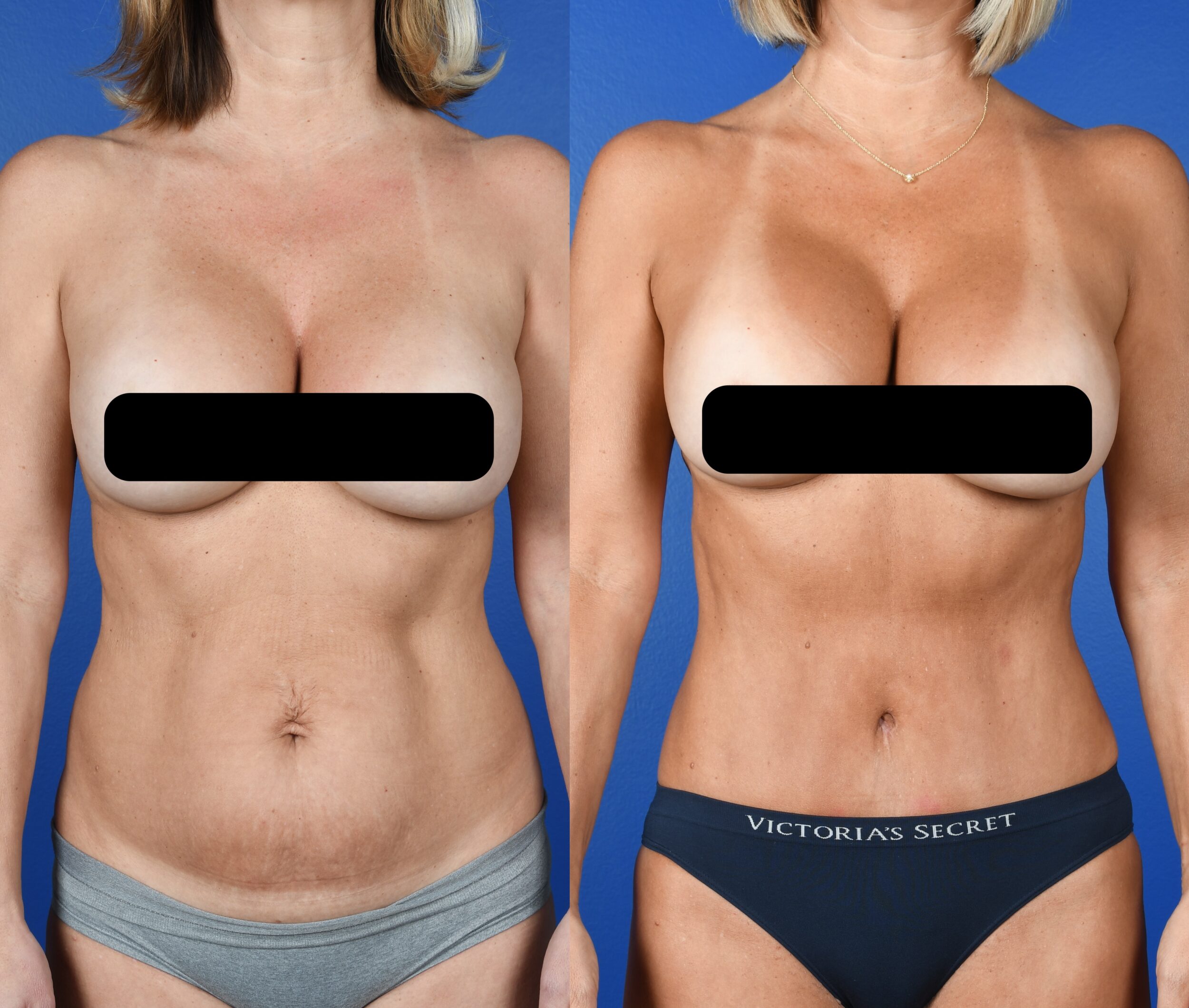 Before and After Image: Abdominoplasty, Flank Liposuction - front