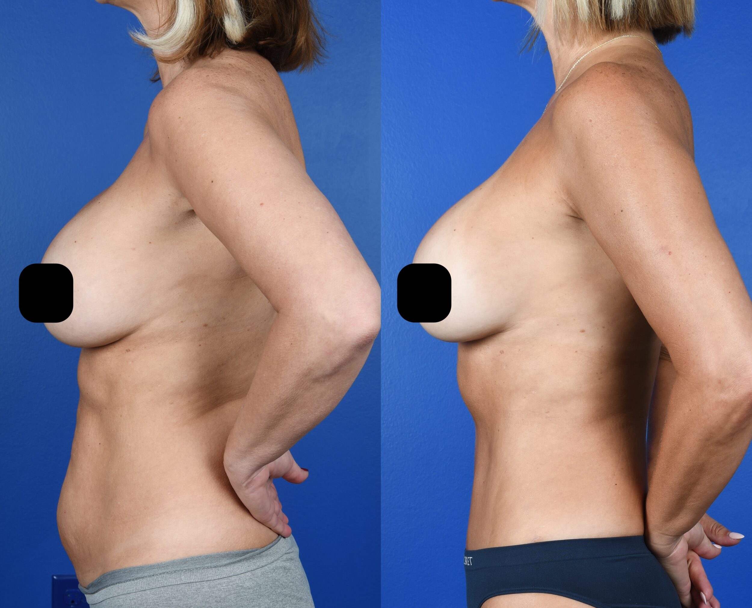 Before and After Image: Abdominoplasty, Flank Liposuction - left-side