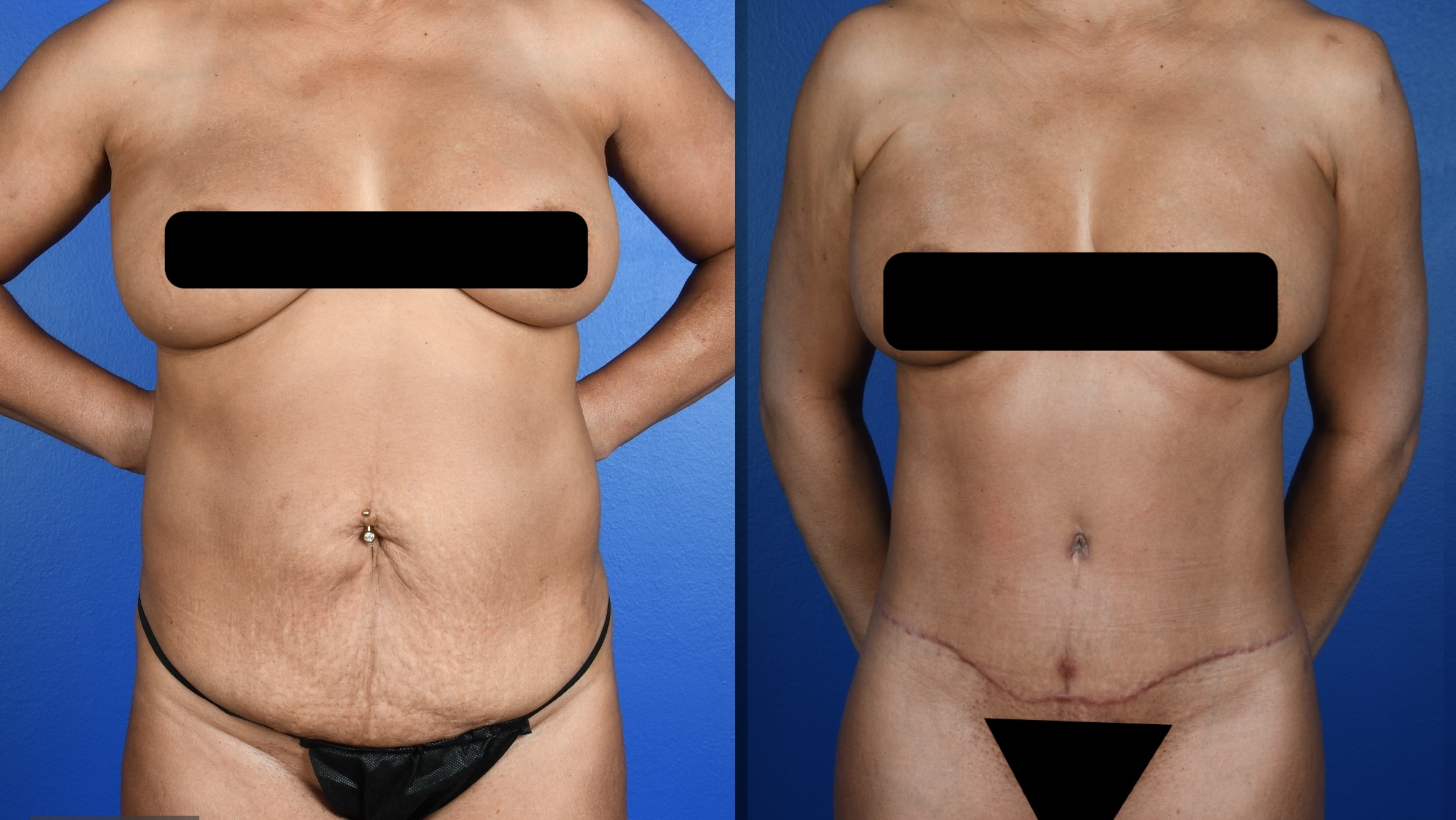 Before and After Image: Standard Abdominoplasty, 360 Liposuction, Liposuction-Upper Back - front