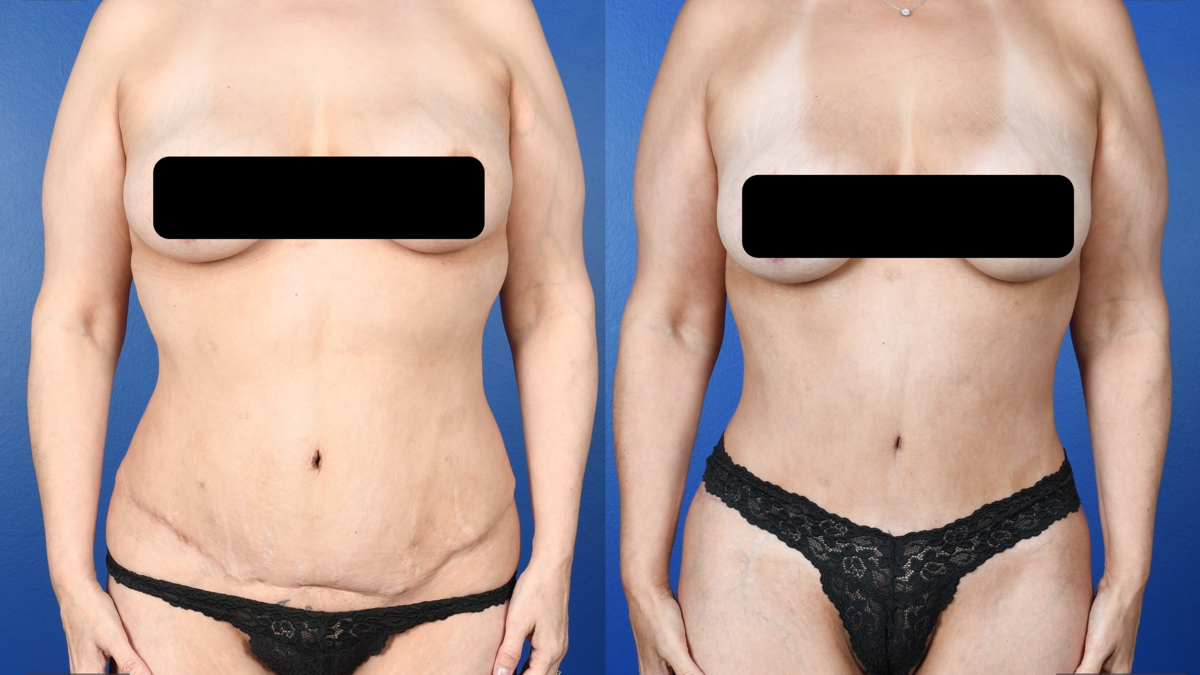 Before and After Image: Lower Bodylift with Gluteal Autoaugmentation, 360 Liposuction, Abdominoplasty Revision - front