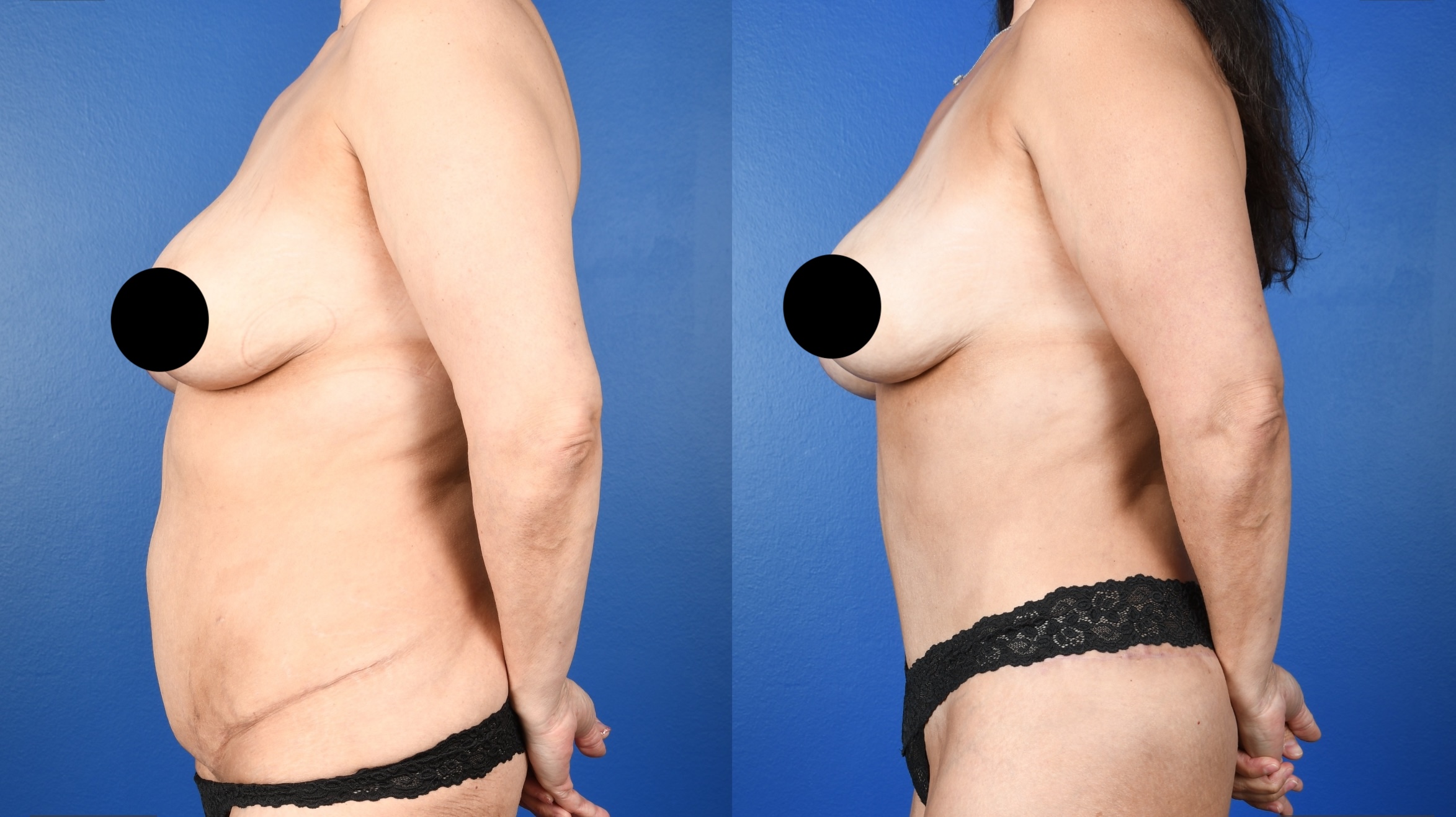 Before and After Image: Lower Bodylift with Gluteal Autoaugmentation, 360 Liposuction, Abdominoplasty Revision - left-side