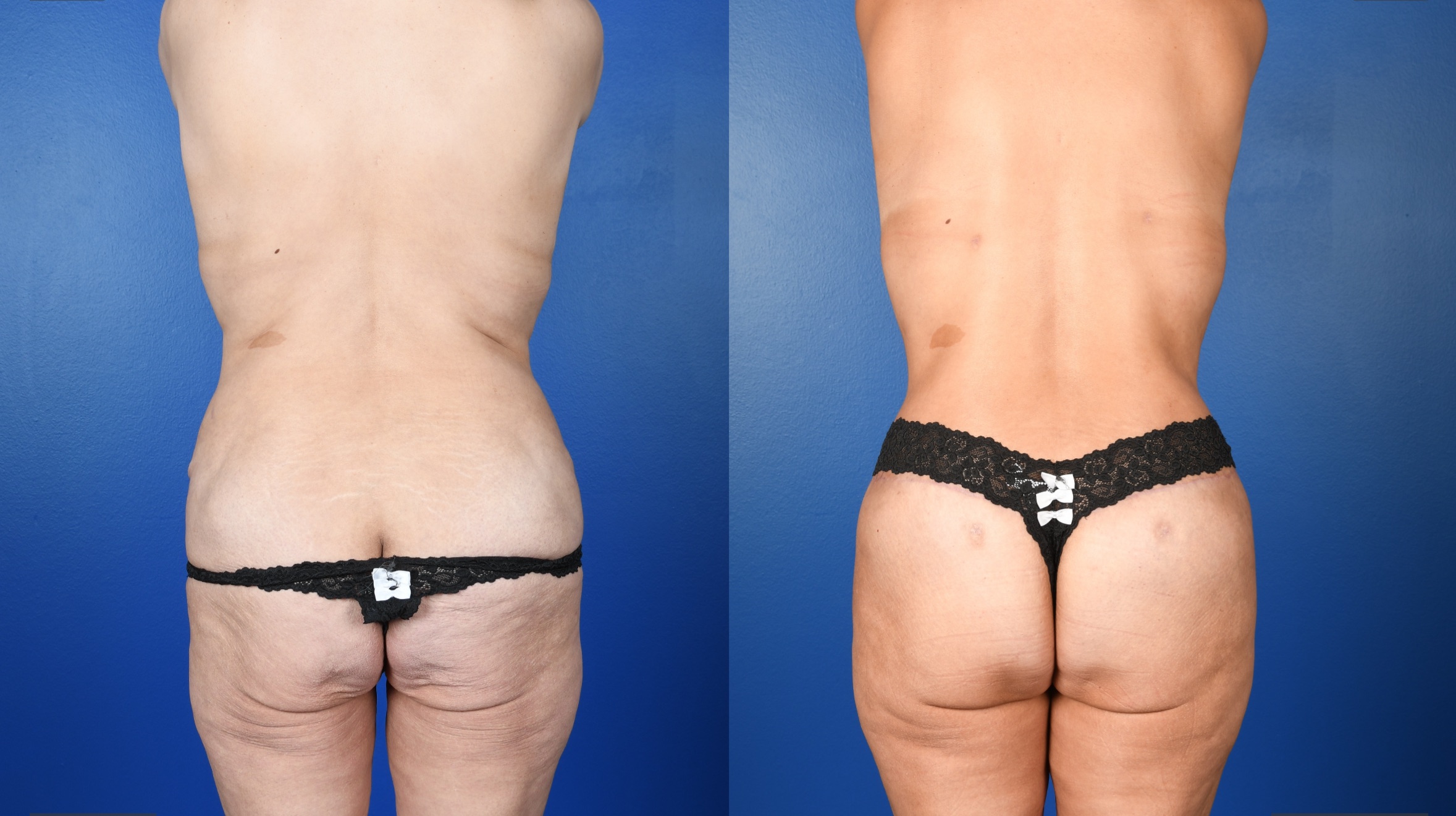 Before and After Image: Lower Bodylift with Gluteal Autoaugmentation, 360 Liposuction, Abdominoplasty Revision - back