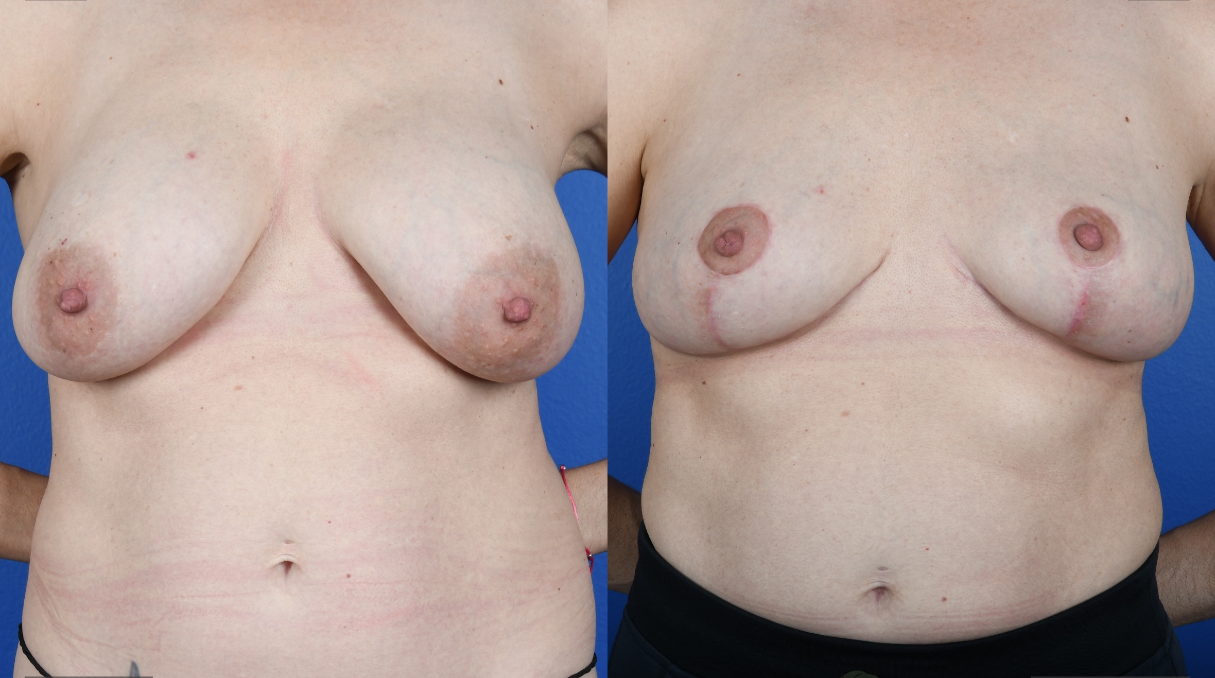 Before and After Image: Breast Implant Removal, Mastopexy, Fat Grafting to Breasts, Galaflex Mesh - front
