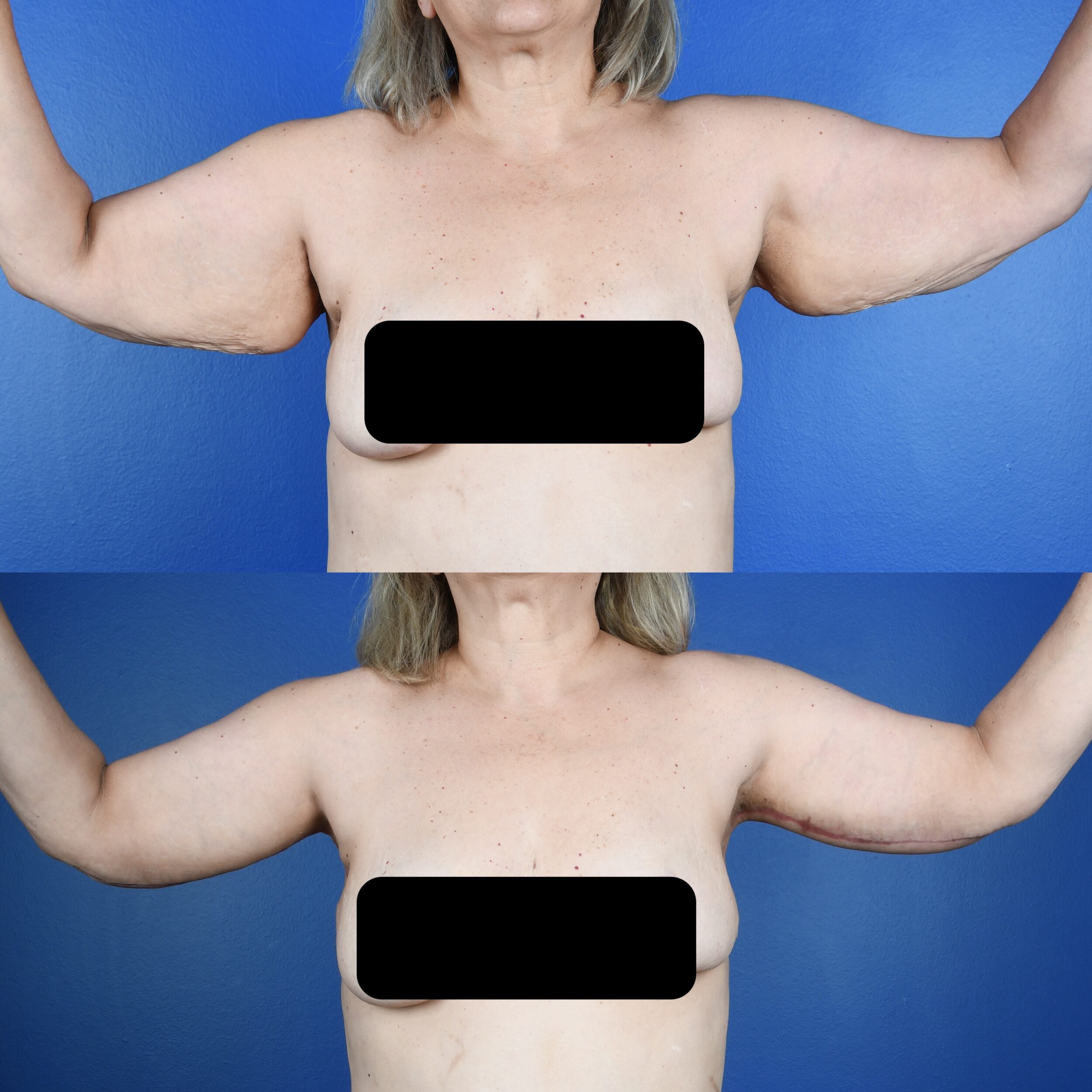 Before and After Image: Brachioplasty - front