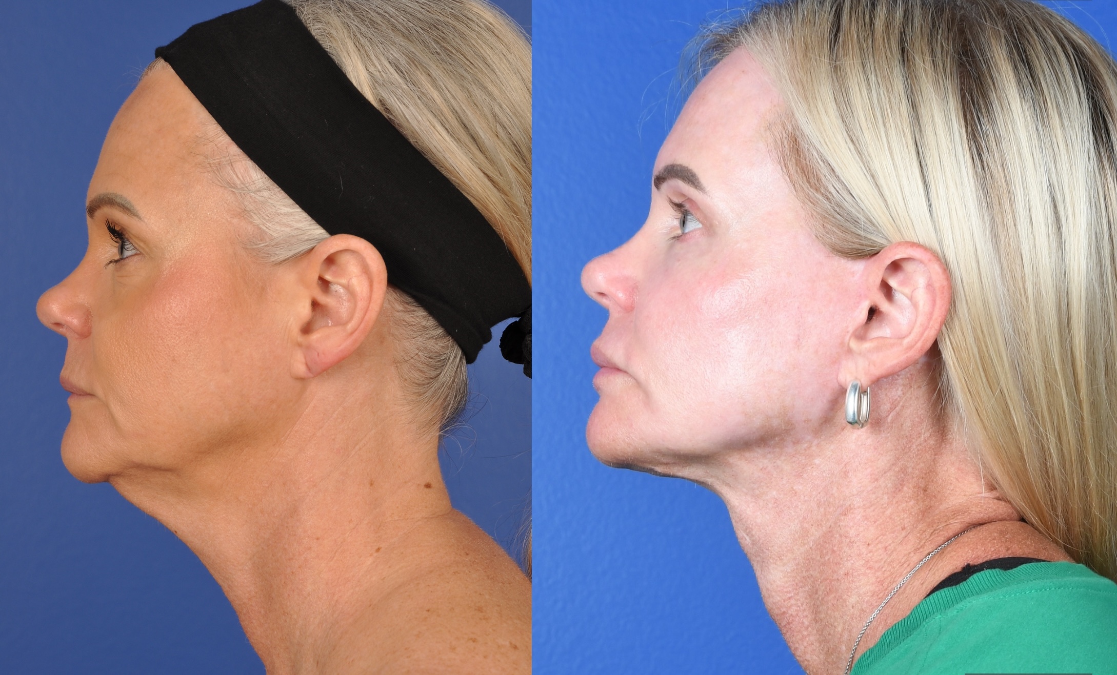 Before and After Image: Facelift, Facial Fat Grafting, Upper and Lower Blepharoplasty, Full Face Laser Resurfacing - left-side