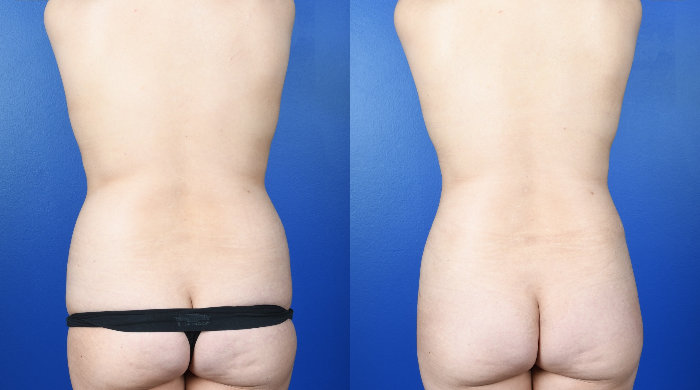 Before and After Image: Extended Abdominoplasty, Flank Liposuction, Breast Augmentation-Silicone - back
