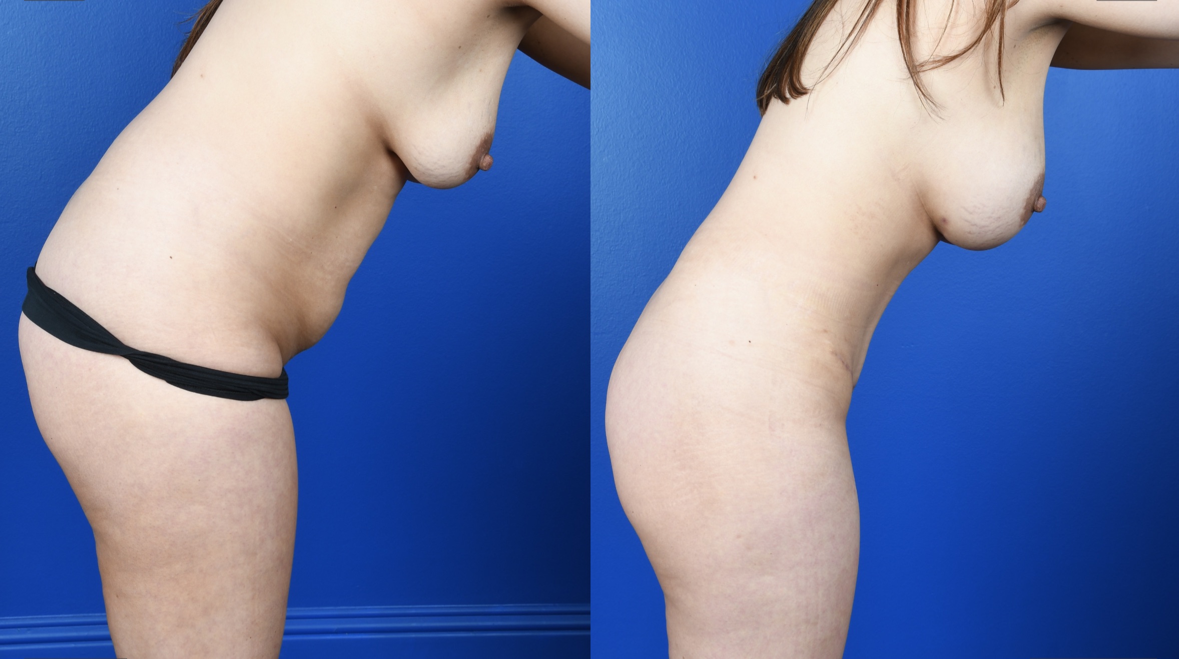 Before and After Image: Extended Abdominoplasty, Flank Liposuction, Breast Augmentation-Silicone - other