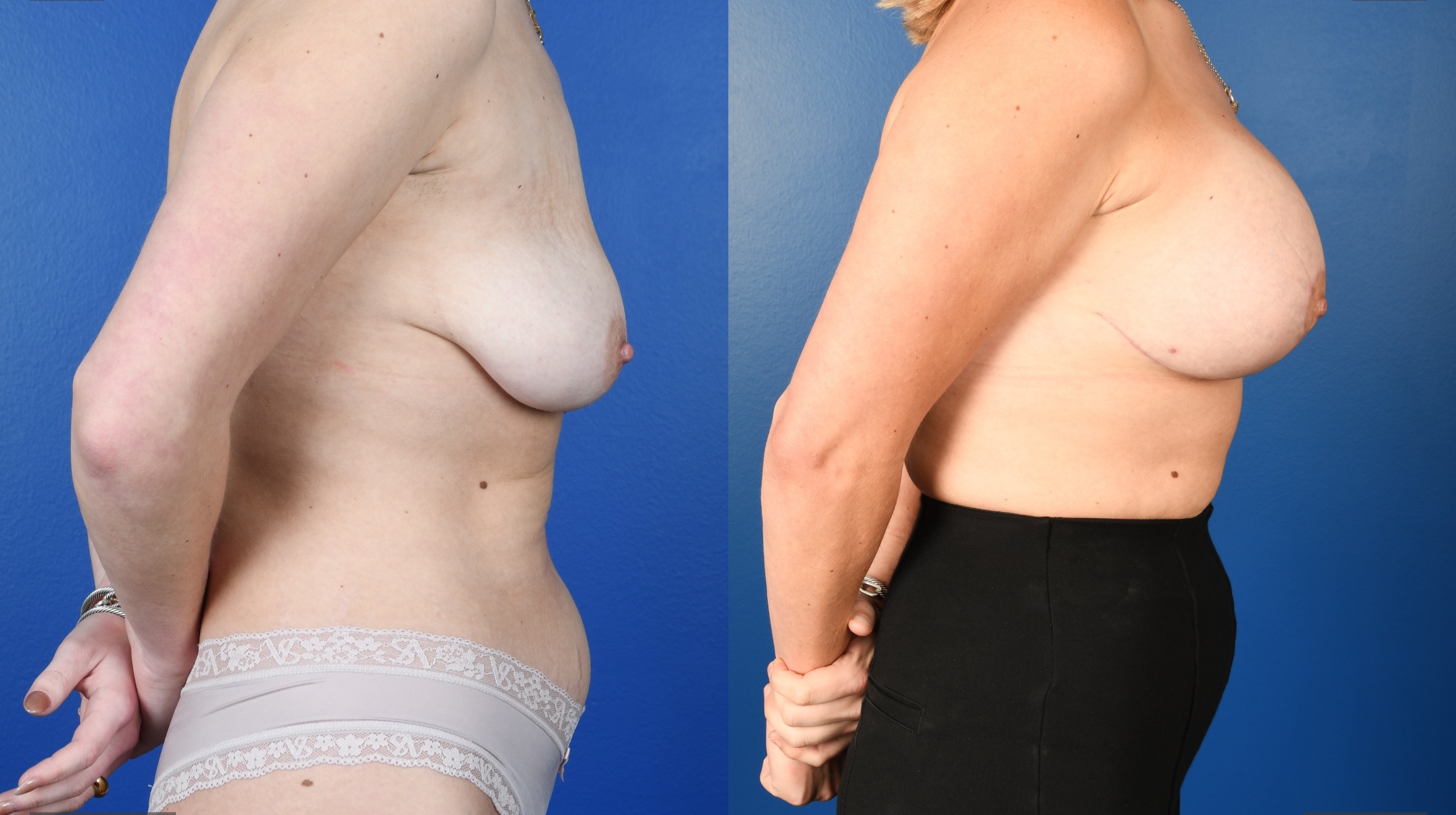 Before and After Image: Mastopexy, Breast Augmentation-Silicone - right-side