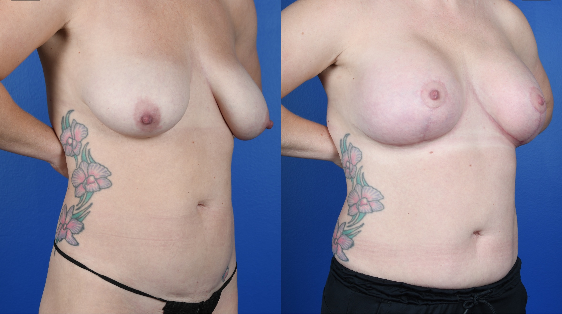 Before and After Image: Breast Augmentation-Allergan Soft Touch, Mastopexy, Belly Button Scar Revision - right-front-oblique