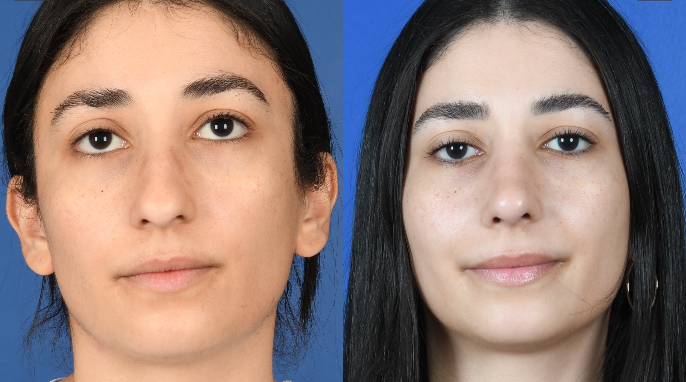Before and After Image: Primary Rhinoplasty - front