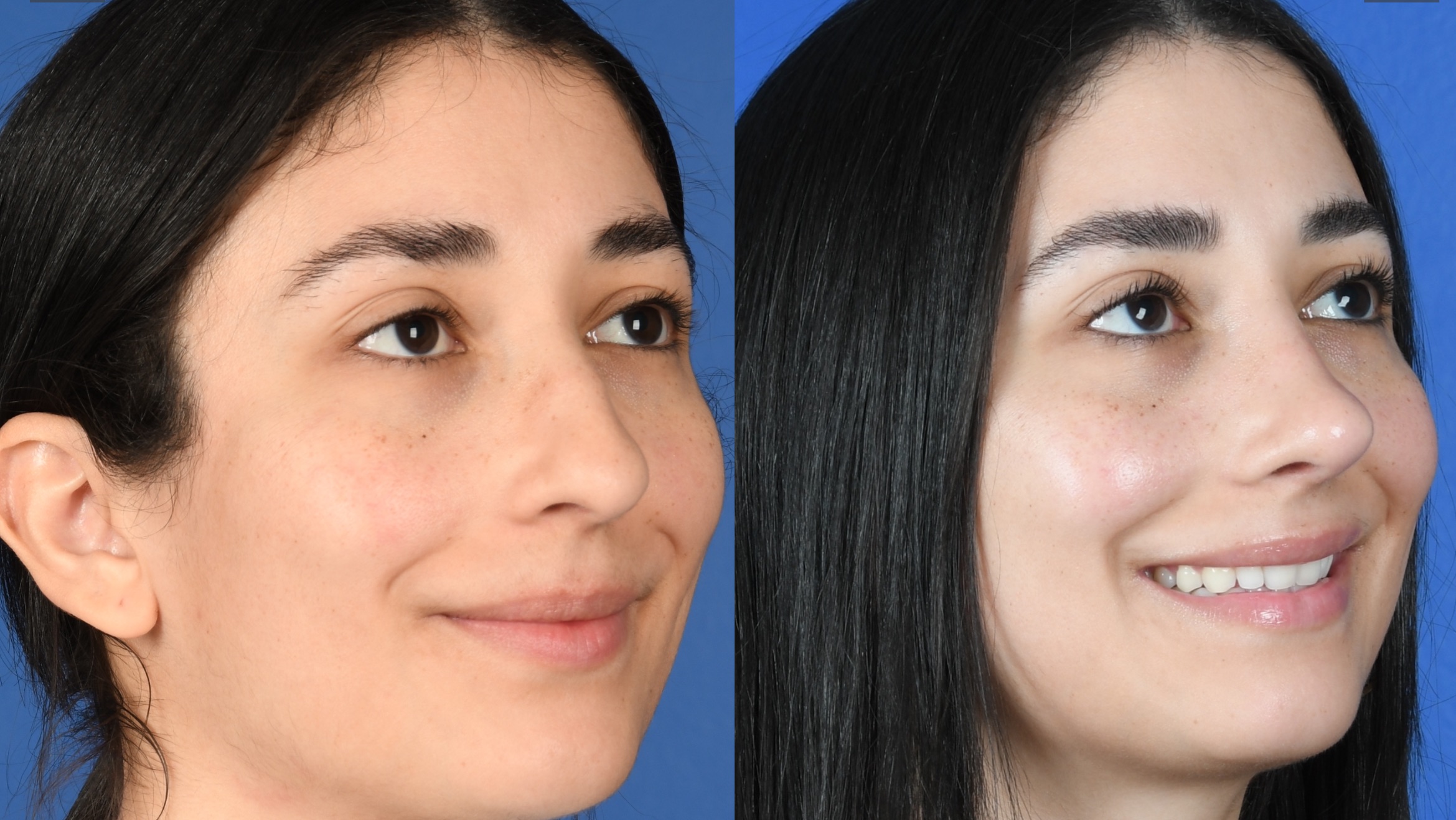 Before and After Image: Primary Rhinoplasty - right-front-oblique