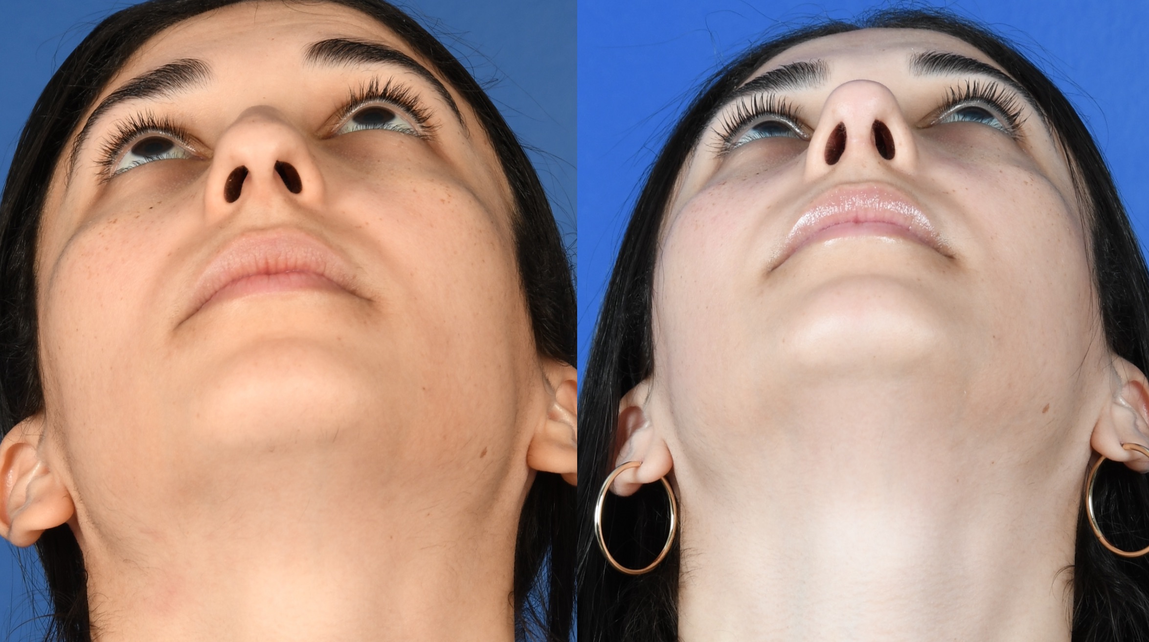 Before and After Image: Primary Rhinoplasty - other