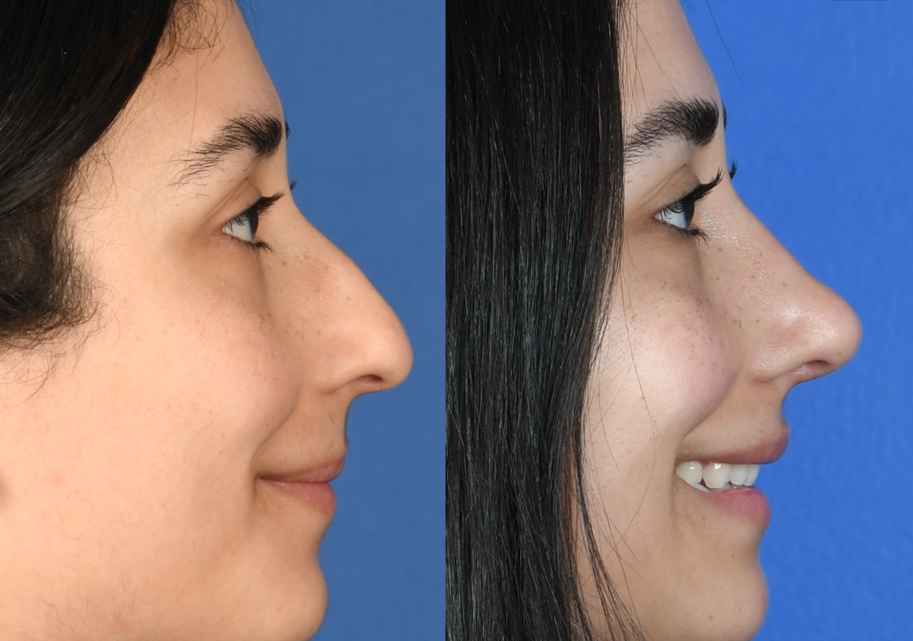 Before and After Image: Primary Rhinoplasty - right-side