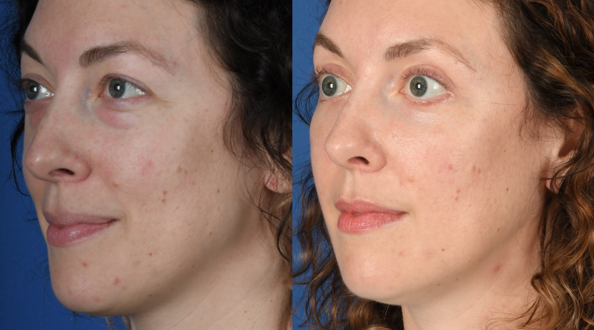 Before and After Image: Upper and Lower Blepharoplasty - left-front-oblique